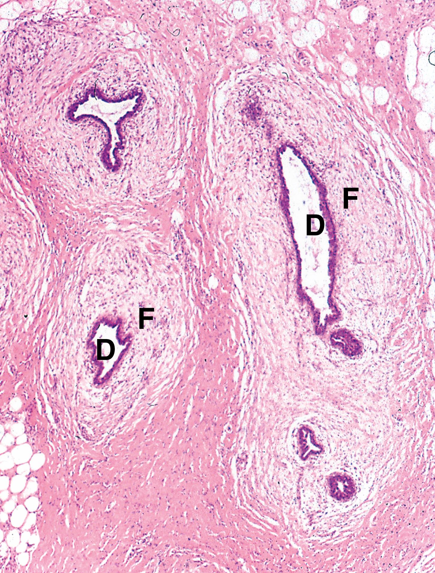 Fig. 18.5, Gynaecomastia of male breast (MP).