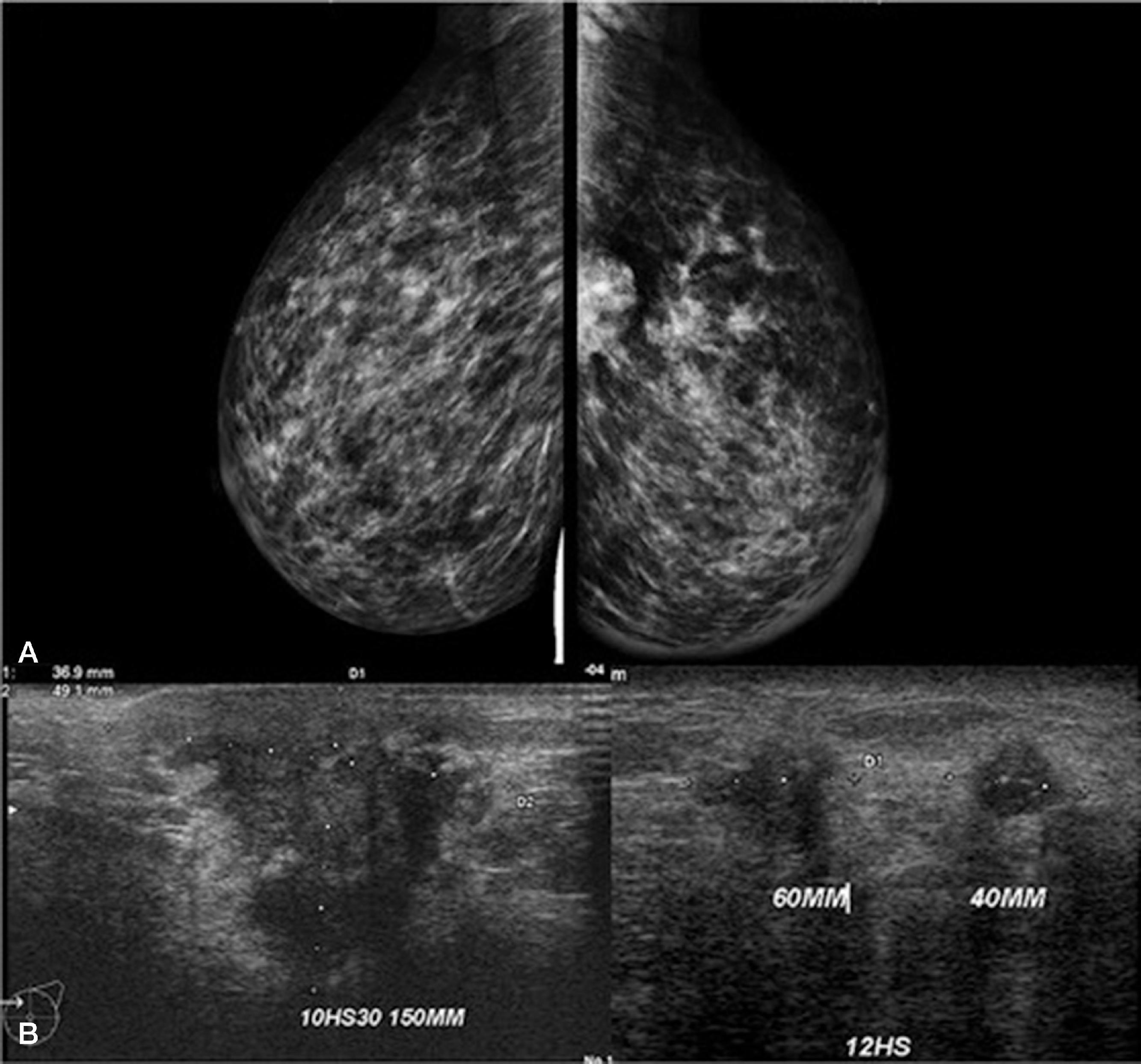 FIG. 3, Inflammatory breast cancer in a 32-year-old woman who is 1 month pregnant. Multifocal lesions in mammography (A) and ultrasound (B) . (Courtesy Dr. Adriana Langer. From Alipour S, Omranipour R, et al., Diseases of the breast during pregnancy and lactation. Advances in Experimental Medicine and Biology, vol 1252. Springer; 2020 . )