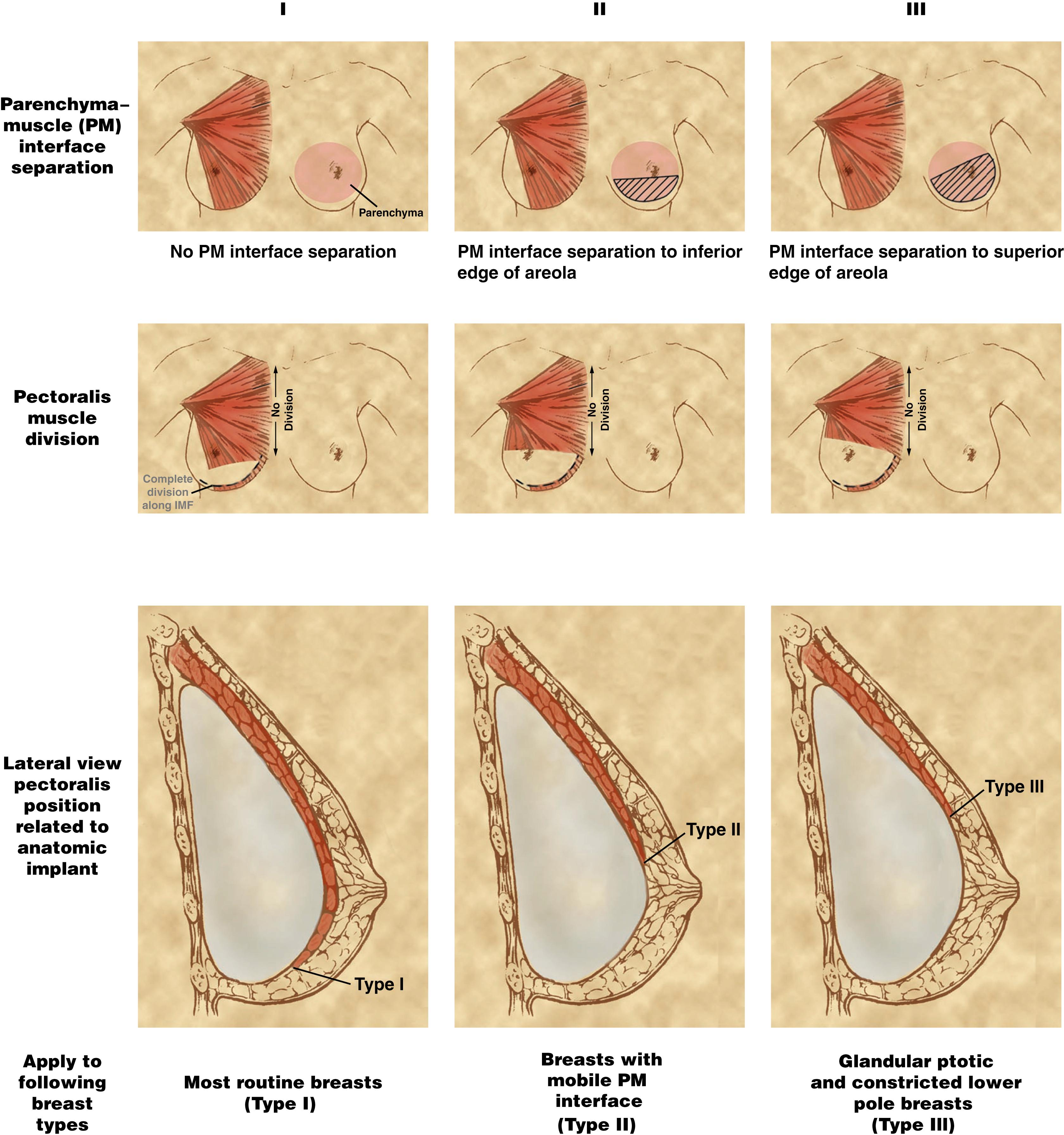 Fig. 35.1, Schematic diagram representing the extent of dissection of breast parenchyma off the pectoralis major and subsequent pectoral release in dual-plane breast augmentation.