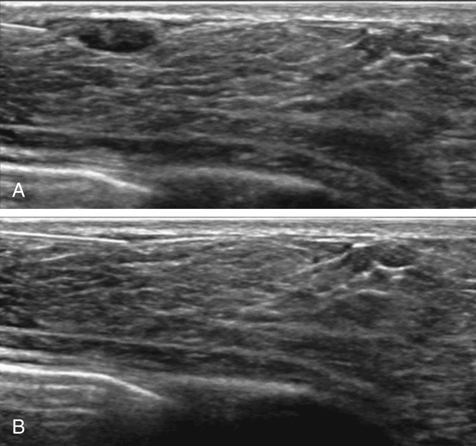 Fig. 105.1, Pre- (A) and post- (B) fine-needle aspiration sonographic images, with complete resolution of the lesion (B).