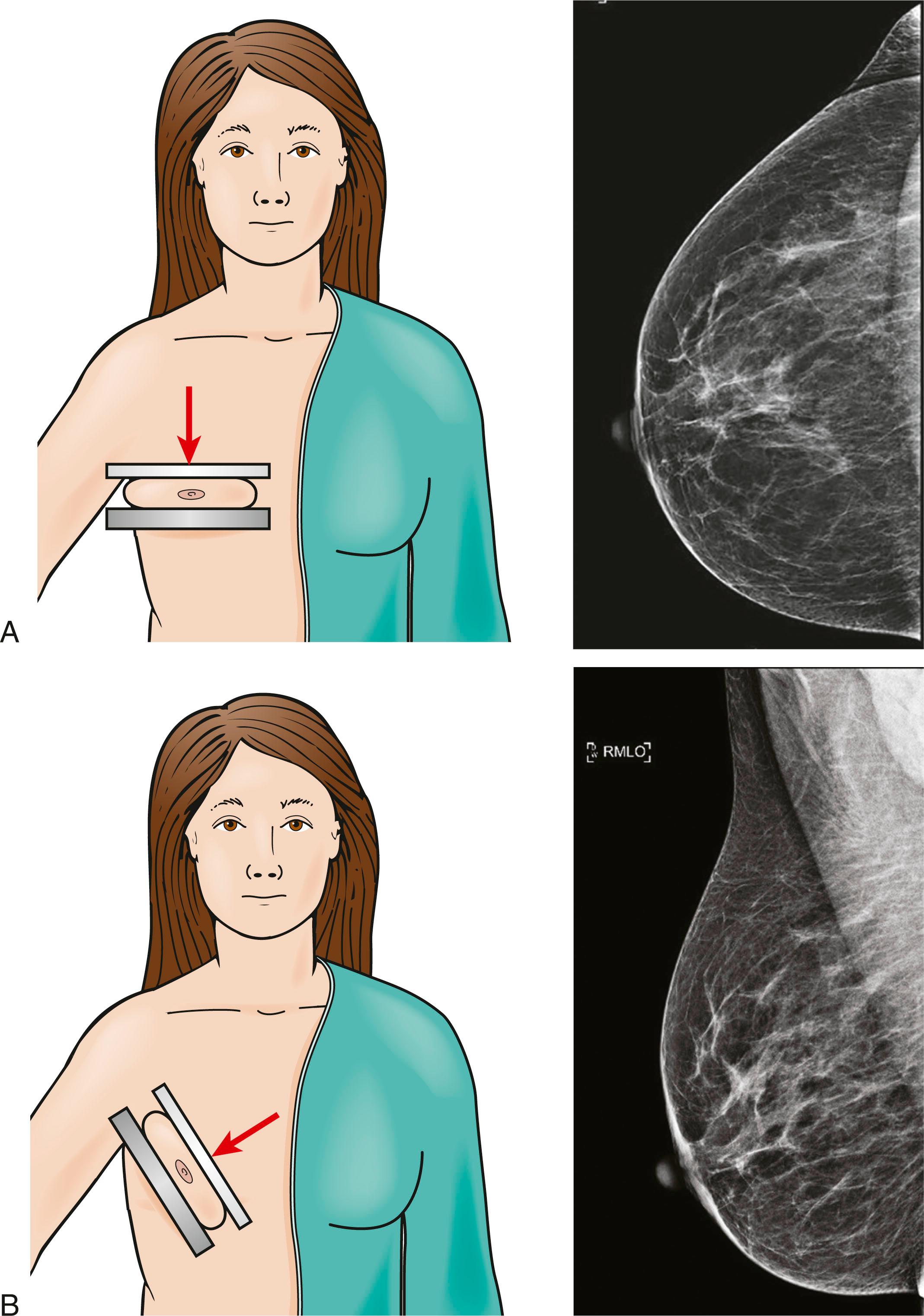 Fig. 12.1, (A) Acquisition of cranio-caudal, and (B) mediolateral oblique views of the right breast.