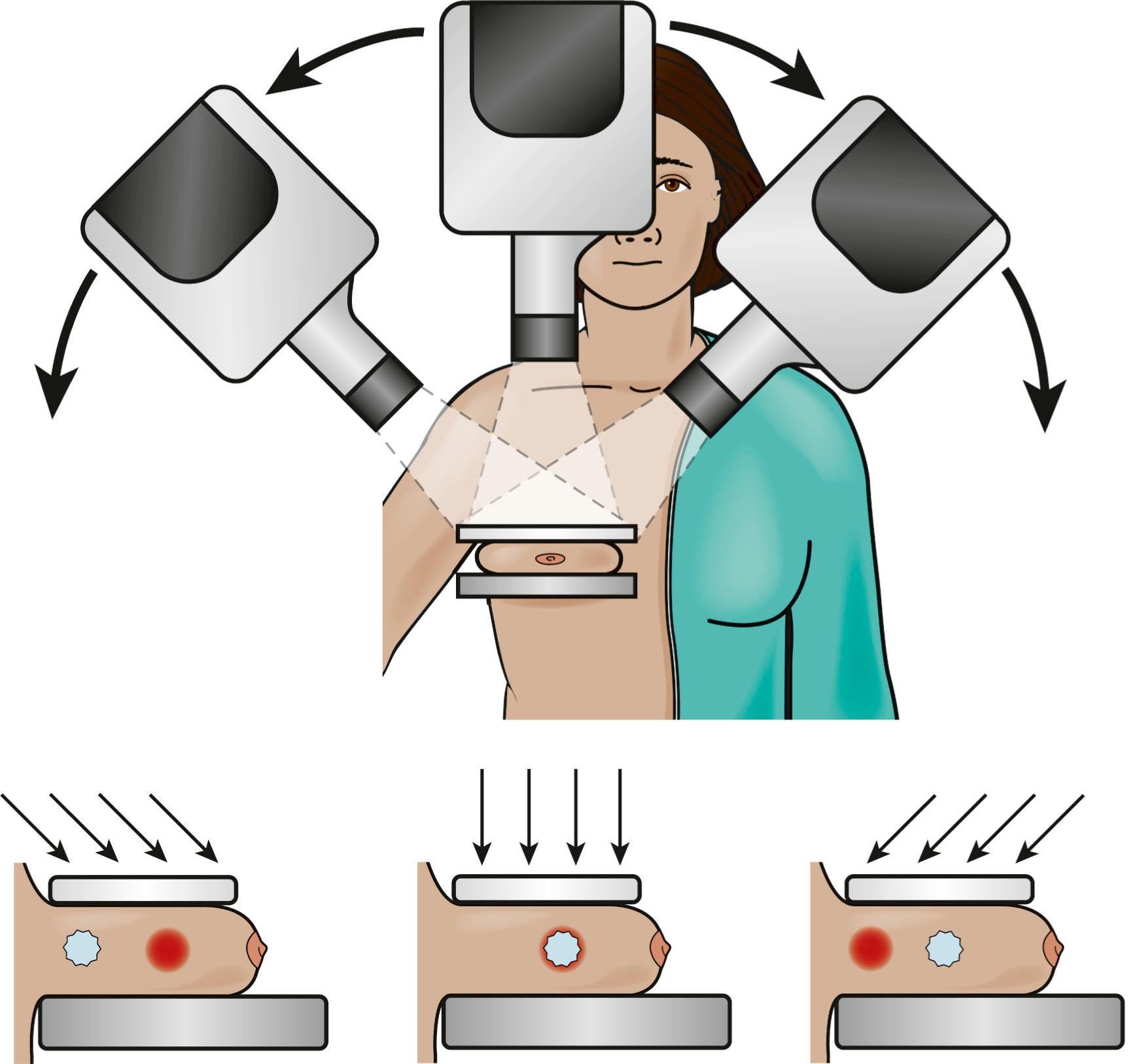 Fig. 12.2, Digital breast tomosynthesis: the x-ray source rotates around the compressed breast, and projection images are formed on the detector. The projection images are then reconstructed into slices.