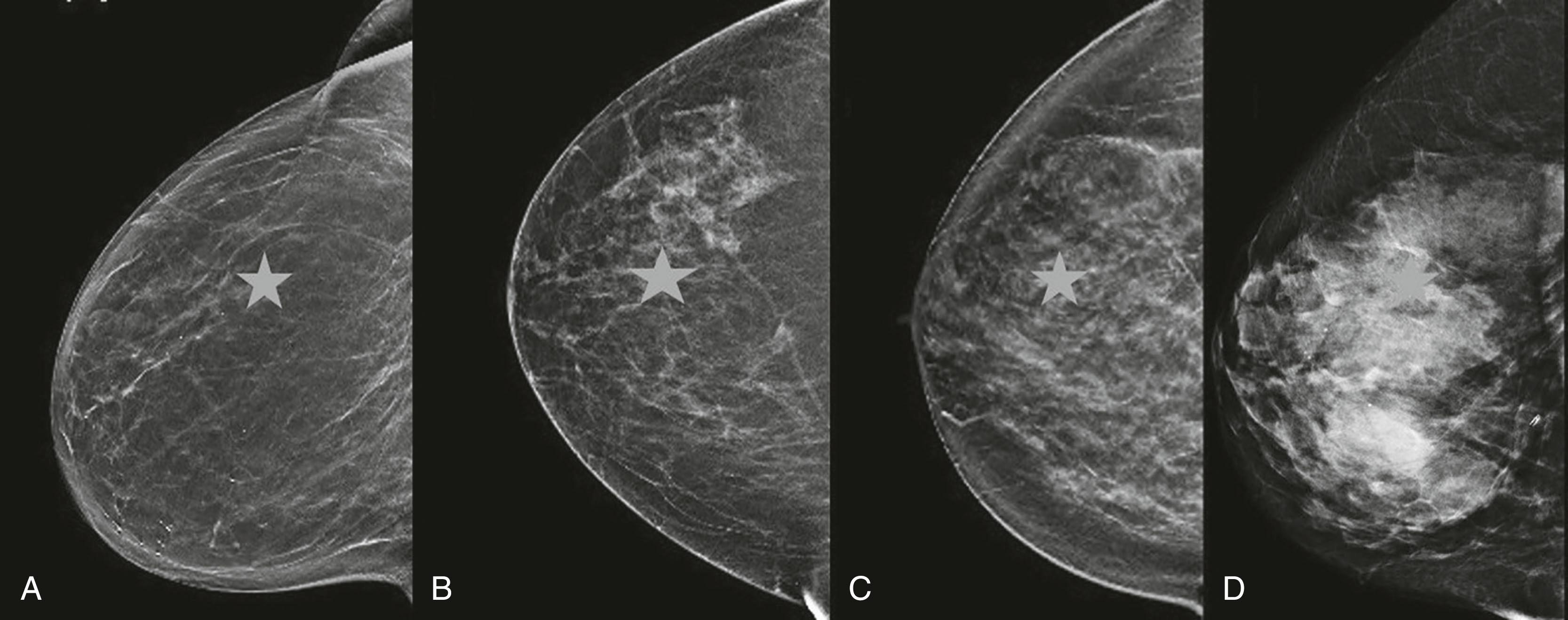 Fig. 12.5, Fibroglandular tissue density categories: (A) fatty, (B) scattered areas of fibroglandular density, (C) heterogeneously dense, and (D) extremely dense. A star shape simulating a suspicious lesion is almost entirely obscured in dense breast.