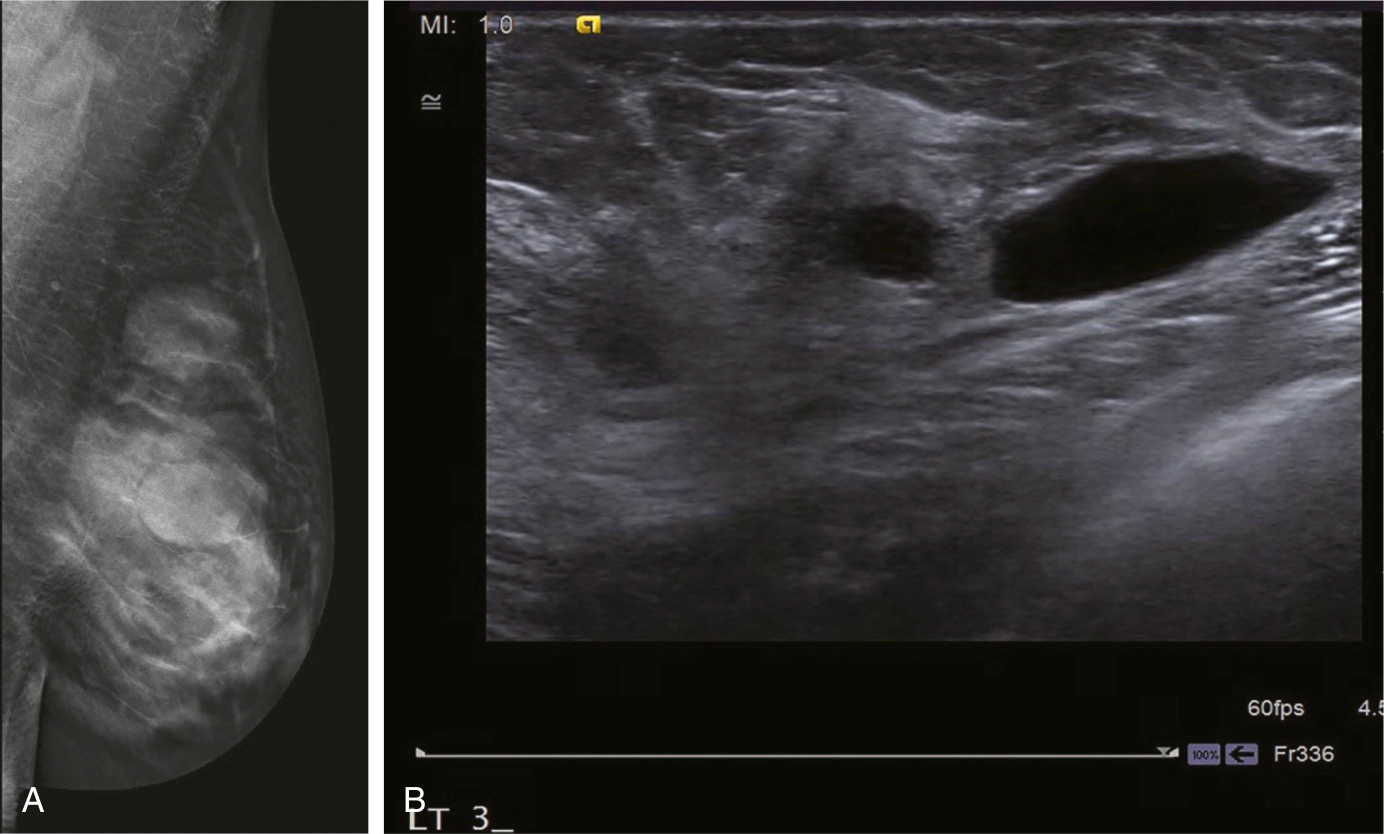 Fig. 12.6, (A) Tomosynthesis mediolateral oblique view demonstrating multiple round masses, most likely benign. (B) Ultrasound image of the same patient demonstrating simple cysts.