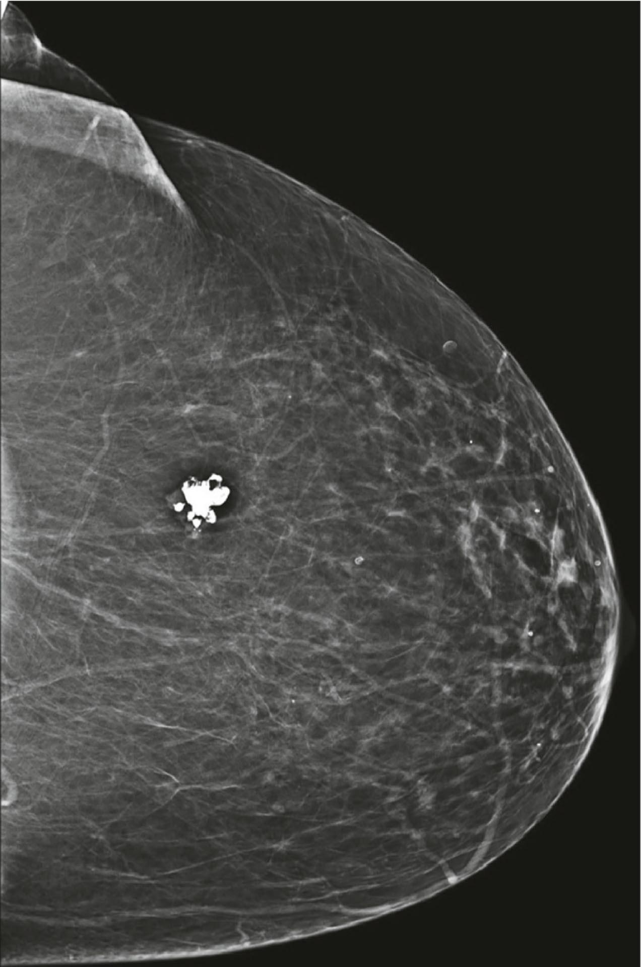 Fig. 12.7, Coarse, “popcorn-like” calcifications typical of a mature fibroademona.