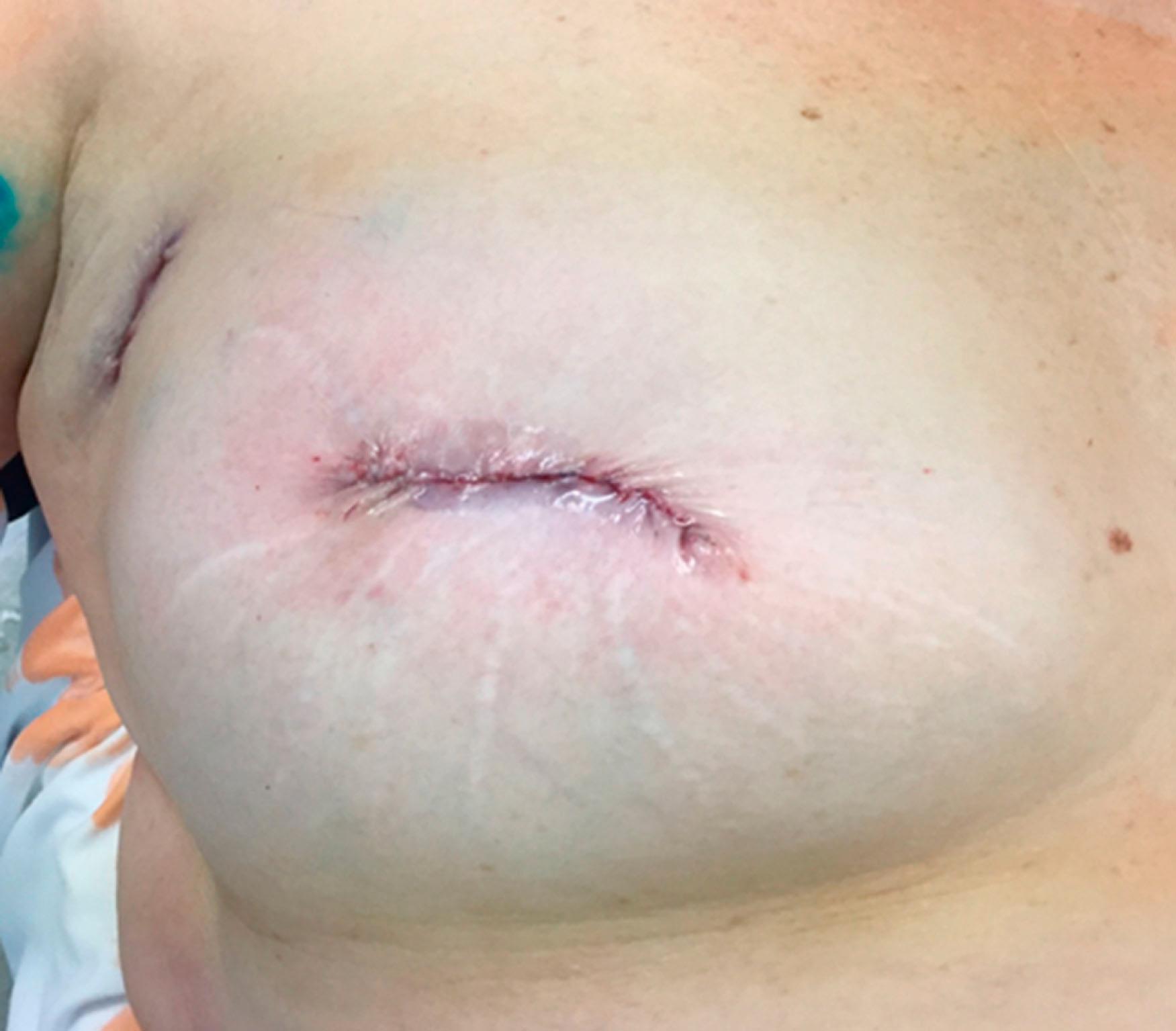 Fig. 31.7, Central lumpectomy with excision of the entire nipple-areolar complex for Paget disease of the nipple. This technique can also be used for a tumor that lies just beneath the nipple-areolar complex.