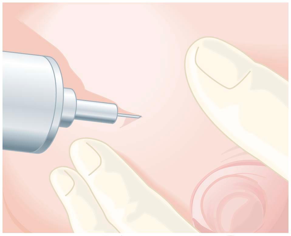 FIGURE 30-1, Aspiration of a breast cyst. Ultrasound may be used to differentiate a solid from a cystic breast mass.