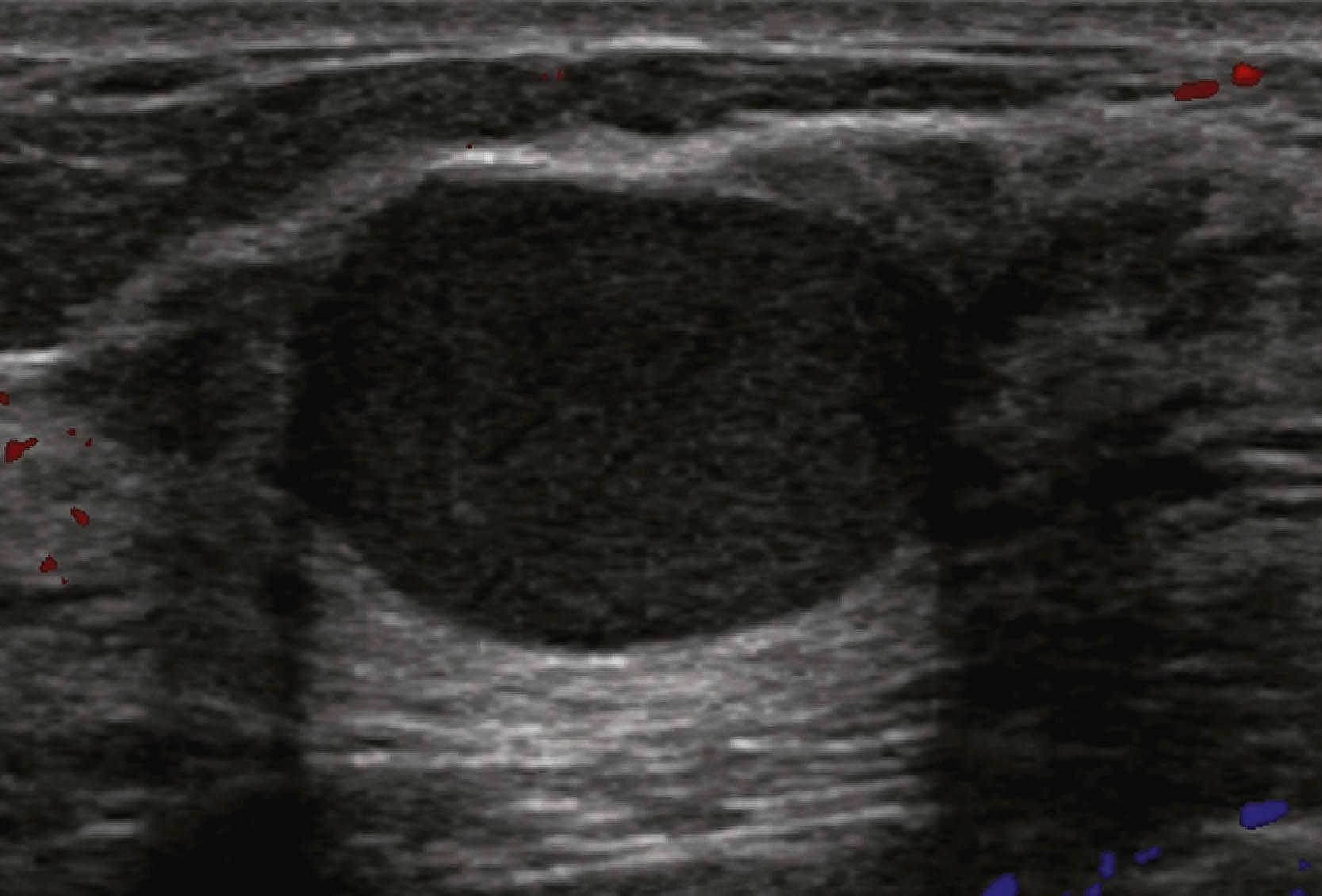Fig. 8.13, A complicated cyst contains low-level internal echoes owing to complex fluid content, is sometimes termed a debris-filled cyst, and cannot be distinguished from a solid mass without aspiration of its contents.