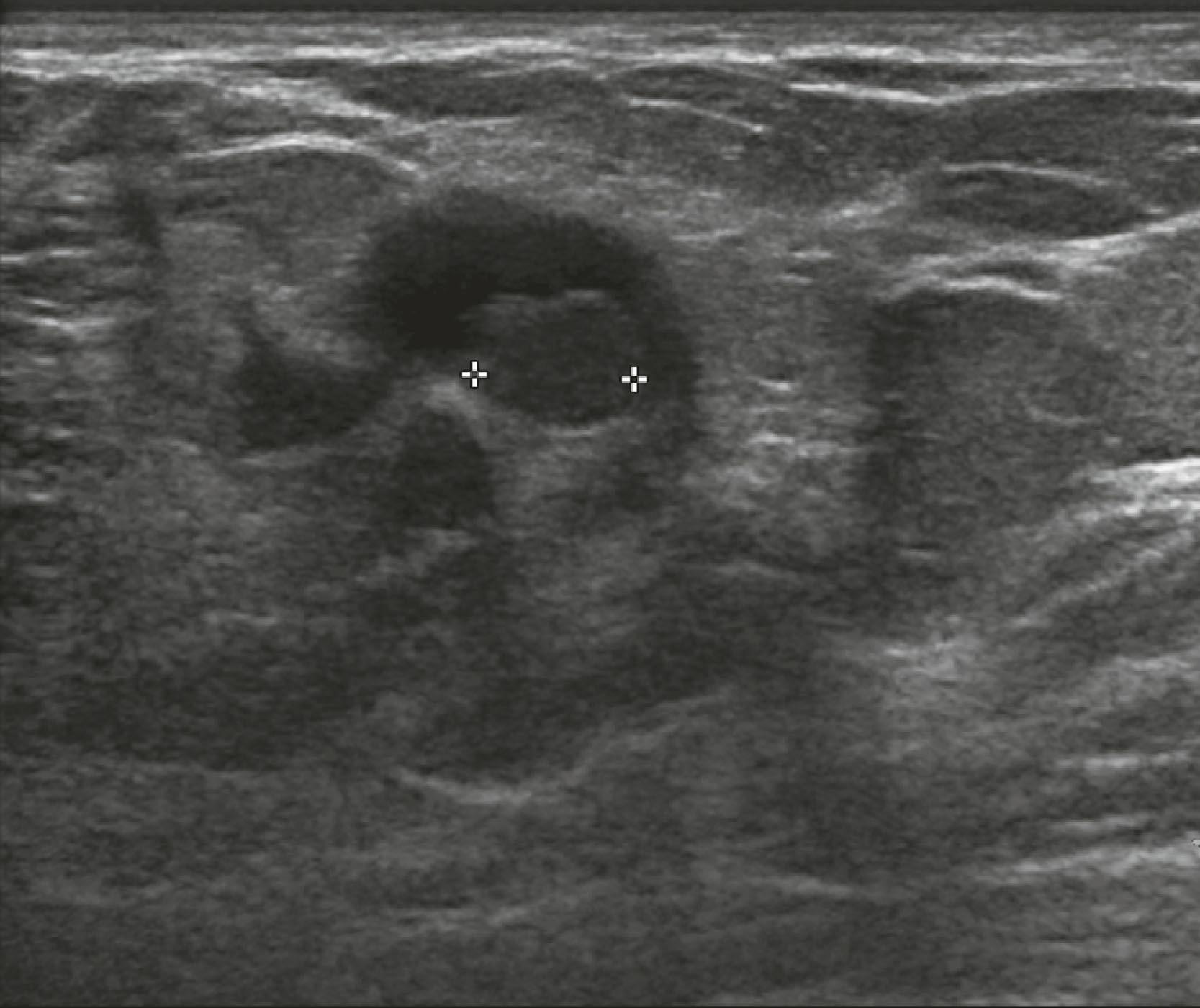 Fig. 8.14, An intracystic papilloma may be seen as a solid mass within a cyst. The patient had a clear nipple discharge.