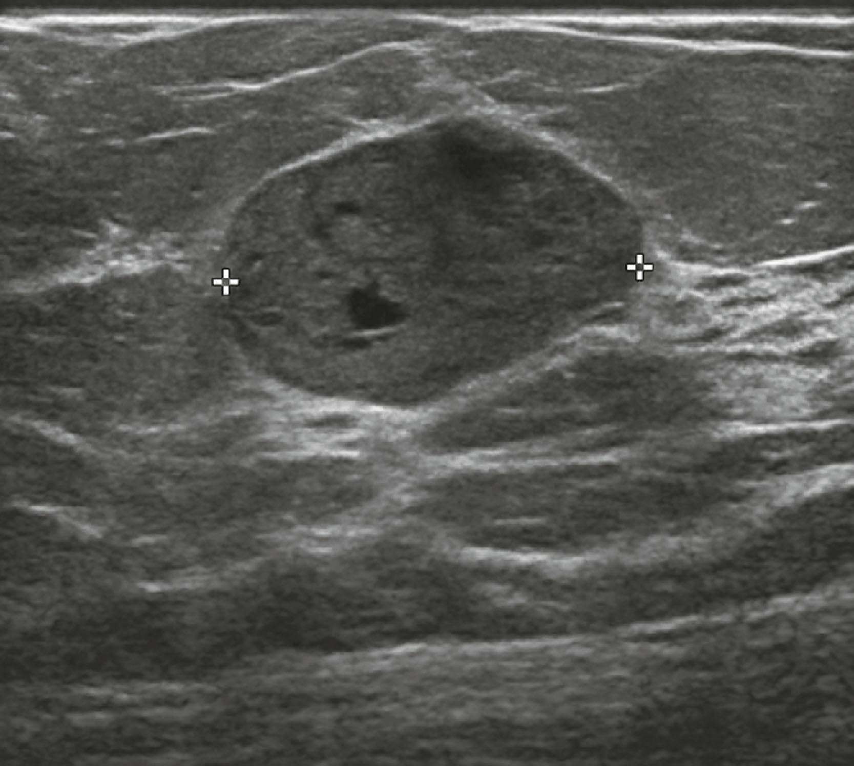 Fig. 8.15, A fibroadenoma typically has well-defined margins and an oval shape with three or fewer gentle lobulations.