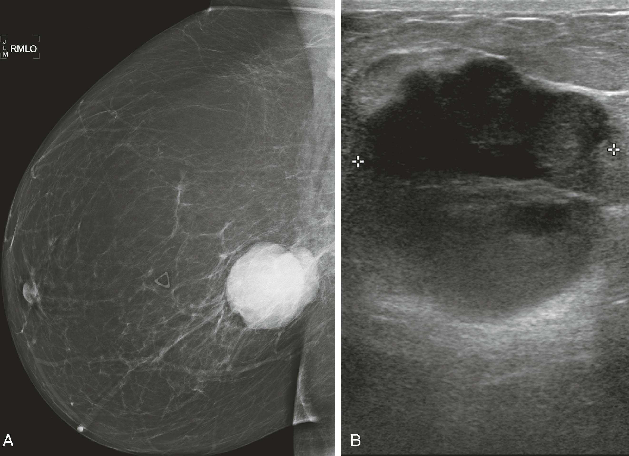 Fig. 8.16, This 4.5-cm palpable mass has well-defined margins on Right Mediolateral Oblique view (RMLO) on mammography ( A ), but on sonography ( B ), it has inhomogeneous internal echoes and a few microlobulations. Biopsy revealed infiltrating duct carcinoma, nuclear grade 3.