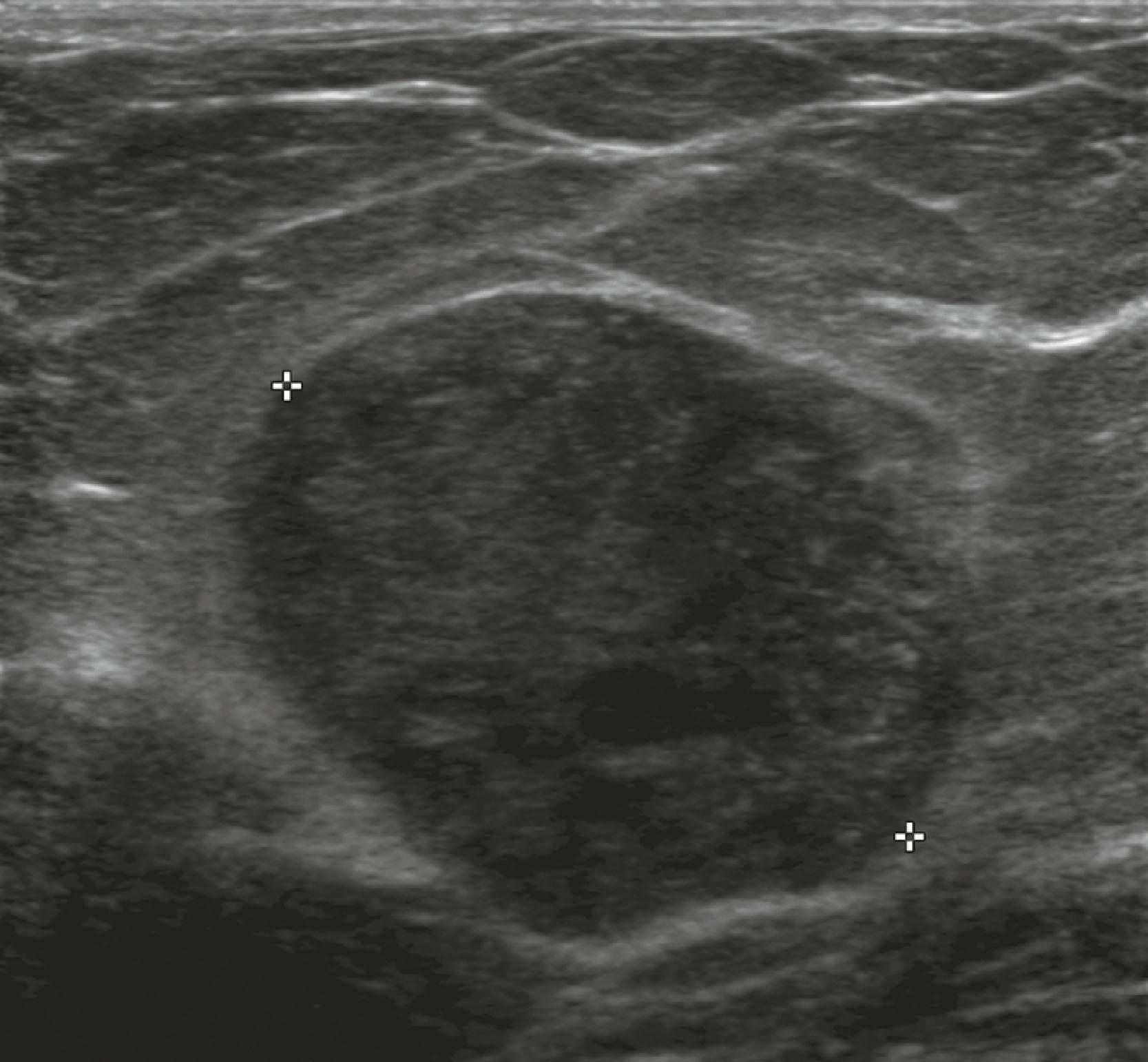 Fig. 8.17, This 3.4-cm palpable malignant phyllodes tumor has circumscribed margins. Pathology revealed mild to moderate pleomorphism, with six mitoses per 10 high-power fields.