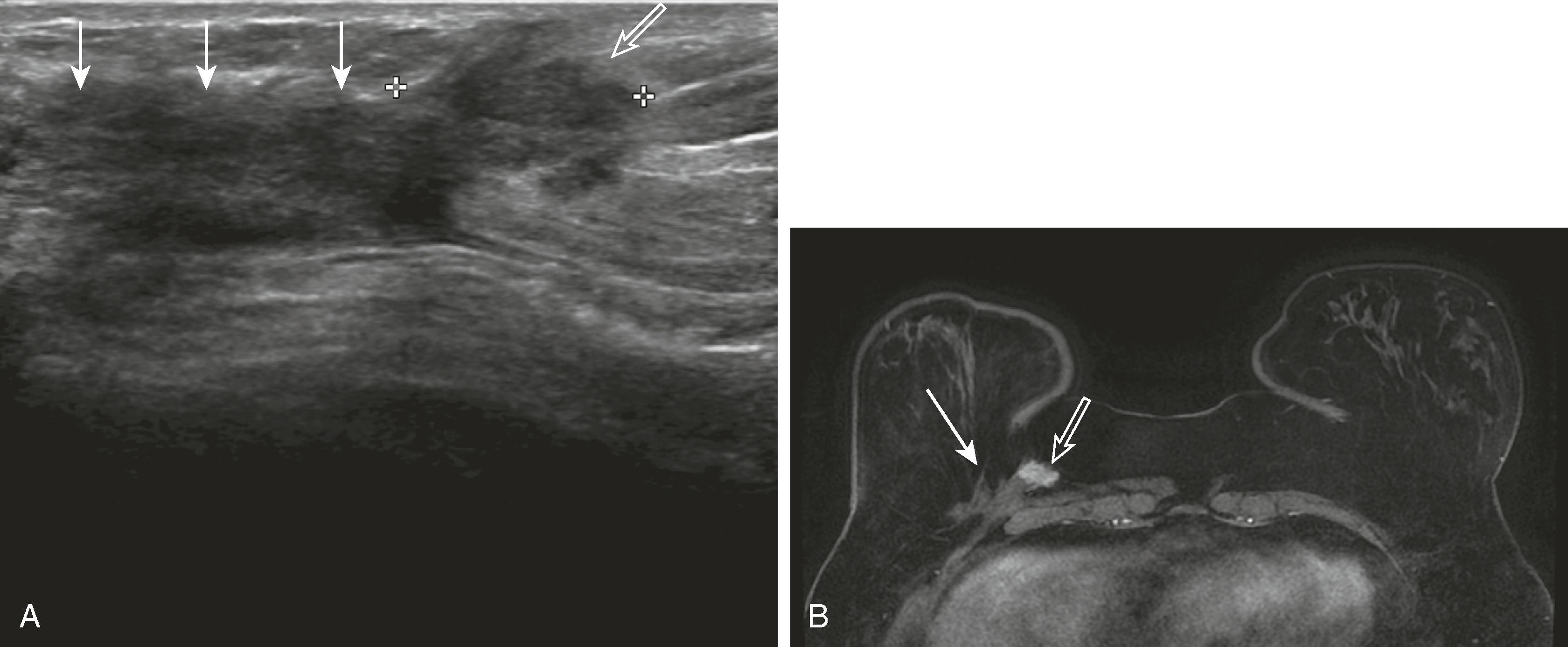 Fig. 8.19, ( A ) A surgical scar is often hypoechoic (solid arrows) and difficult to distinguish from a mass (open arrow) , requiring correlation with the location of the lumpectomy site on mammography and physical examination. ( B ) The hypoechoic mass merging with the scar was identified by its enhancement on magnetic resonance imaging (open arrow) , seen medial to the scar (solid arrow) . Ultrasound-guided core biopsy revealed recurrent invasive ductal carcinoma.