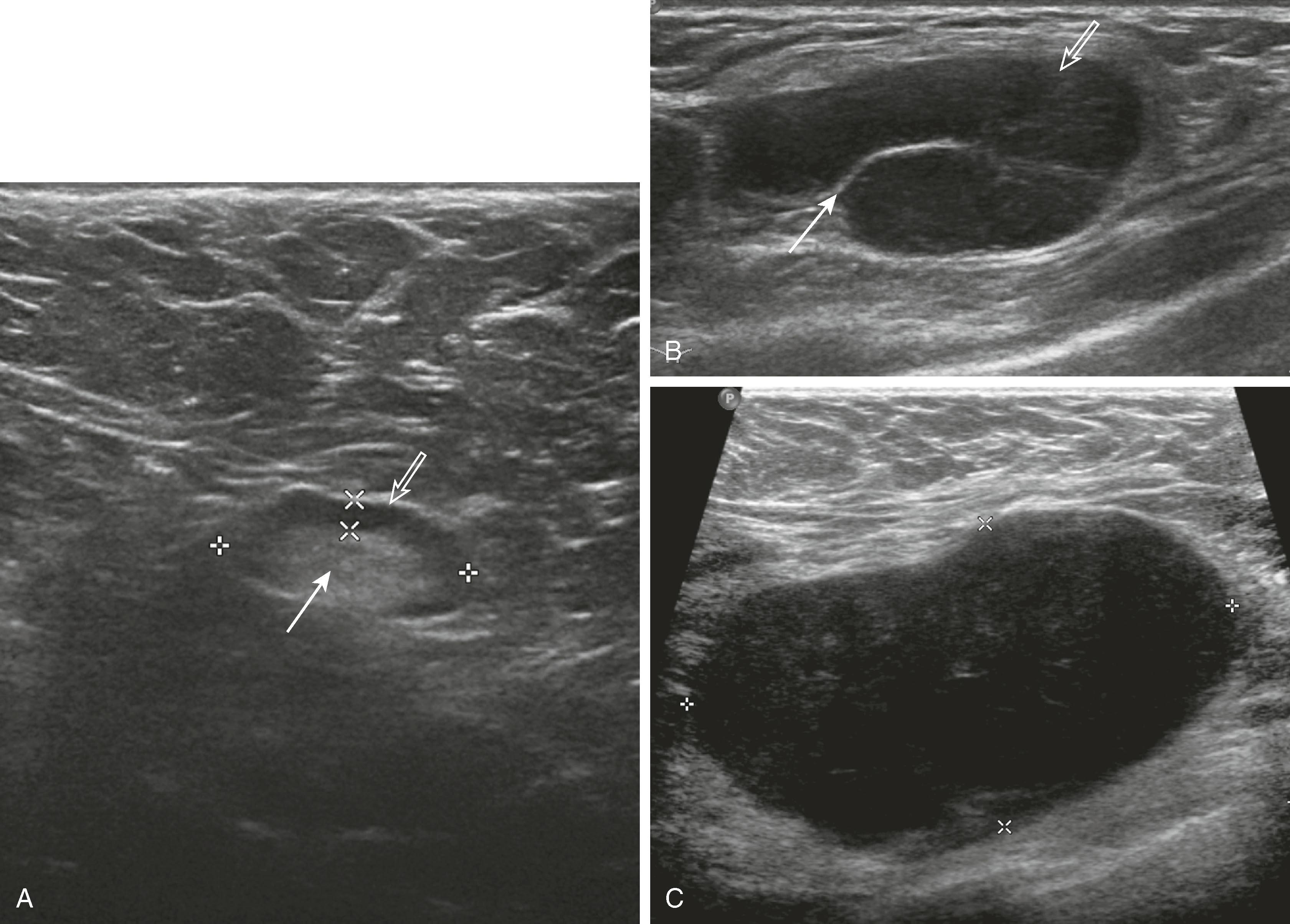 Fig. 8.21, ( A ) A normal lymph node has a thin cortex (open arrow) and a visible hilus (solid arrow) . An abnormal lymph node has a thickened cortex ( open arrow in B ), which may compress the hilus ( solid arrow in B ) or render the hilus invisible ( C ). A grossly abnormal lymph node may lose the normal bean shape and smooth margin.