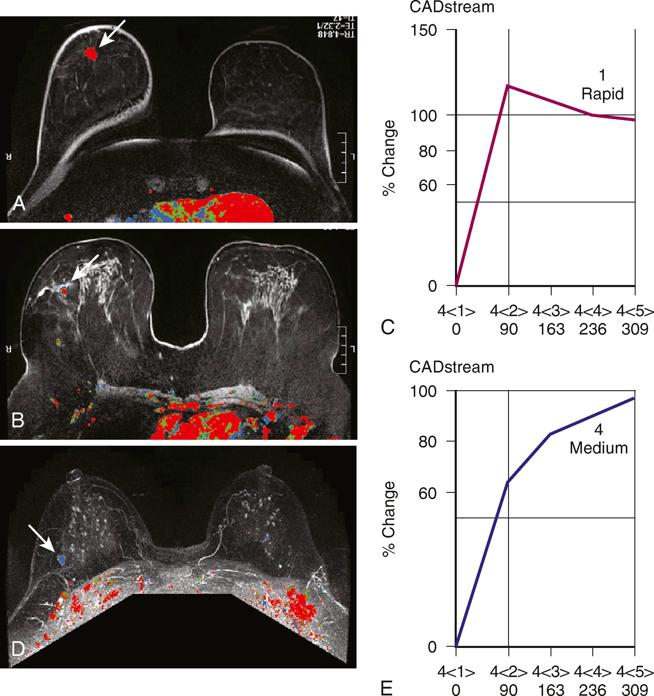 Fig. 8.22, ( A and B ) Two examples of malignant lesions (arrows) , colored red by computer-aided detection (CAD). ( C ) The curve shows the typical “kinetic signature” of cancer, which is quick enhancement, followed by rapid washout. ( D ) Magnetic resonance imaging with CAD demonstrates a fibroadenoma within the right breast (arrow) , colored blue by CAD. ( E ) The washout curve for this fibroadenoma shows persistent accumulation of contrast.