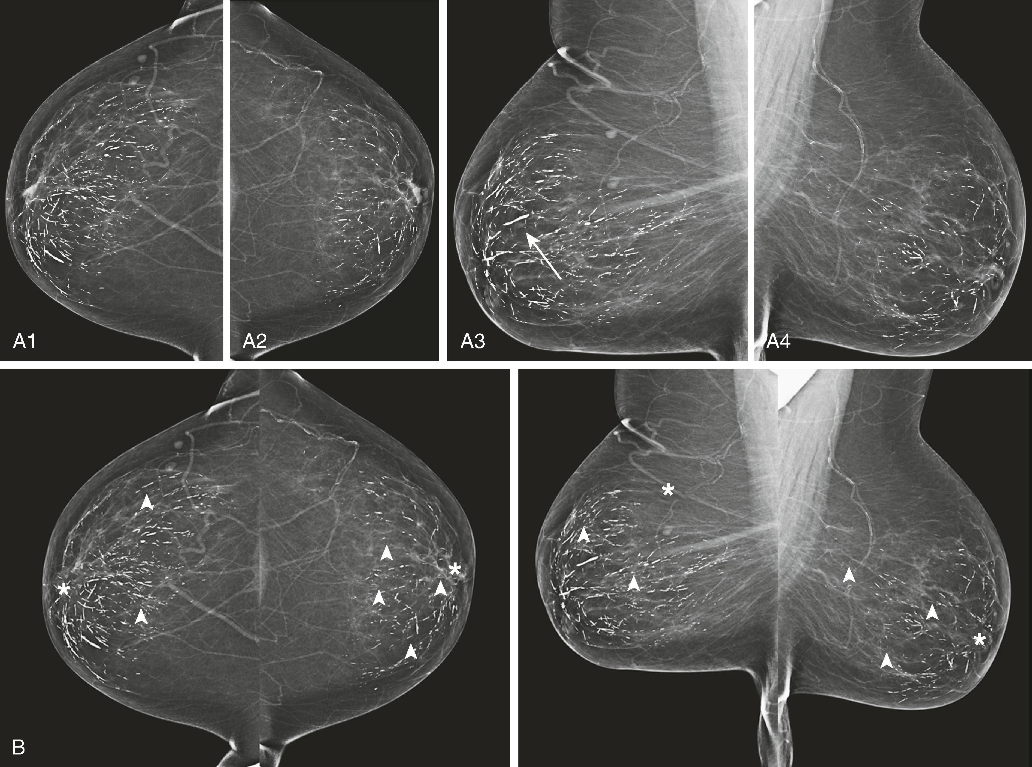 Fig. 8.4, ( A1 – A4 ) Diffuse bilateral benign secretory calcifications are present (arrow on linear calcification) [ A3 ]). ( B ) Computer-aided detection images have numerous marks, all denoting benign stable findings ( arrowheads , calcifications; asterisks , masses).
