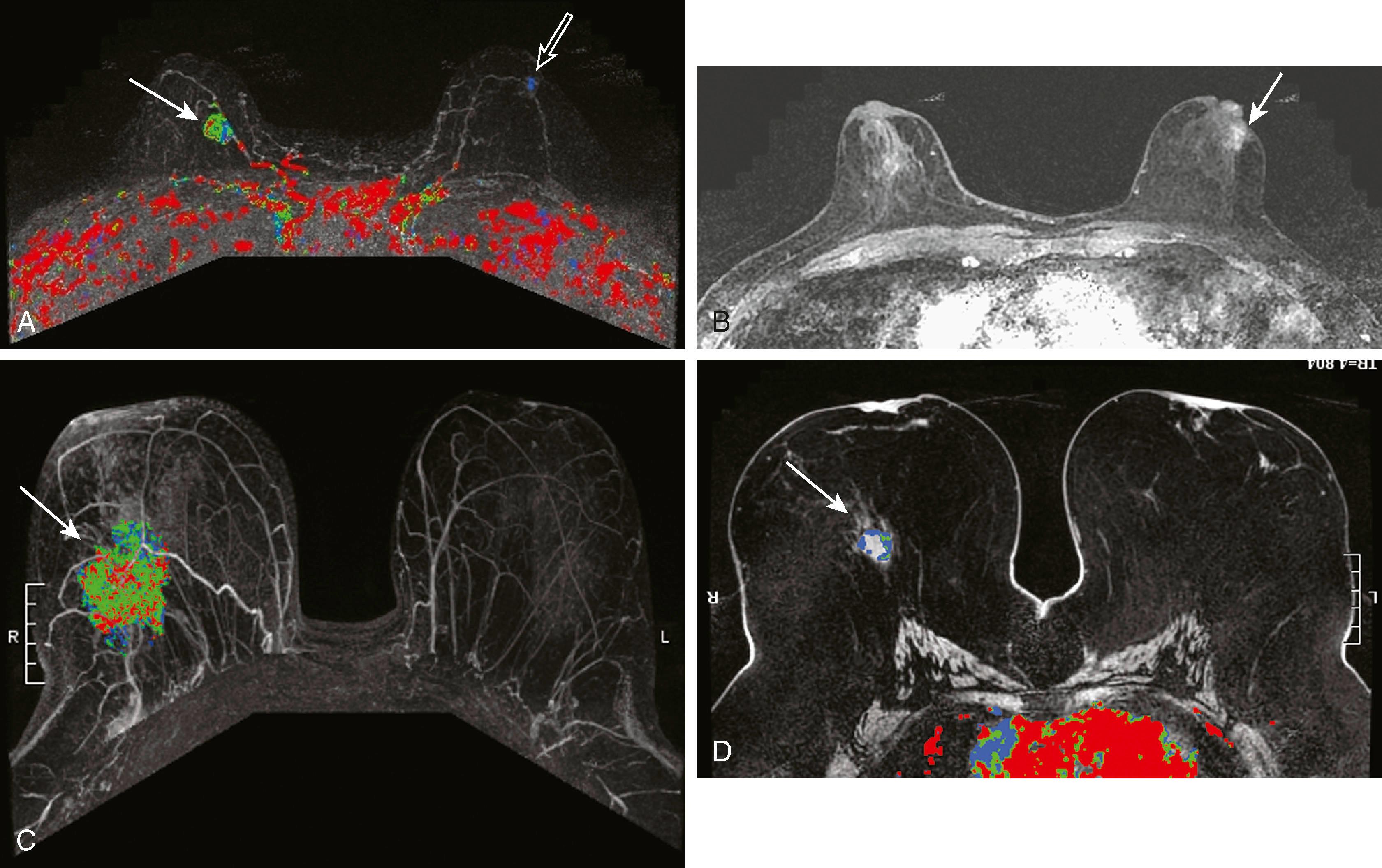 Fig. 8.23, ( A ) Maximal intensity projection with computer-aided detection demonstrates a carcinoma within the right breast (solid arrow) showing a heterogeneous kinetic pattern of red, green, and blue, which is actually most typical for carcinoma. The left breast (open arrow) demonstrates a lesion showing benign washout; however, it is a carcinoma. ( B ) Although the kinetic profile is benign, the morphology of this lesion was malignant (arrow) . ( C ) Large invasive ductal carcinoma demonstrates a heterogeneous kinetic pattern (arrow) . ( D ) Carcinoma demonstrates a ring of predominantly blue enhancement (arrow) . Ring enhancement, however, is a malignant morphological feature.