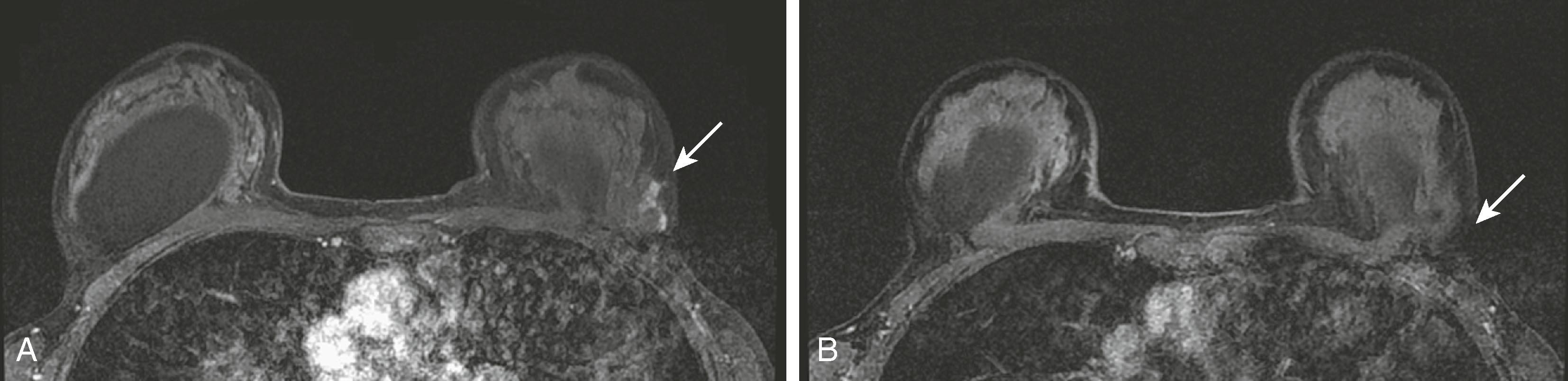 Fig. 8.24, ( A ) Breast magnetic resonance imaging (MRI) performed in the latter part of the menstrual cycle demonstrates enhancement in the lateral aspect of the patient’s breast (arrow) . ( B ) The patient had a repeat MRI in the first half of her menstrual cycle, and the physiological enhancement is no longer visible (arrow) .