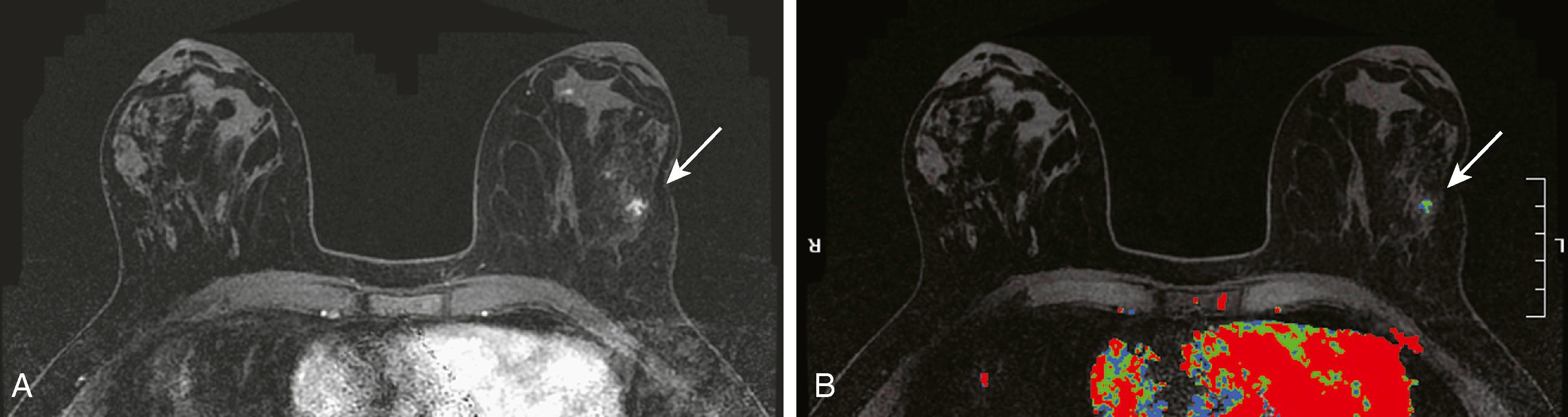 Fig. 8.26, ( A ) Magnetic resonance imaging (MRI) demonstrates nonmass enhancement (arrow) within the lateral left breast. ( B ) MRI with computer-aided detection shows a predominantly plateau pattern enhancement (arrow) .