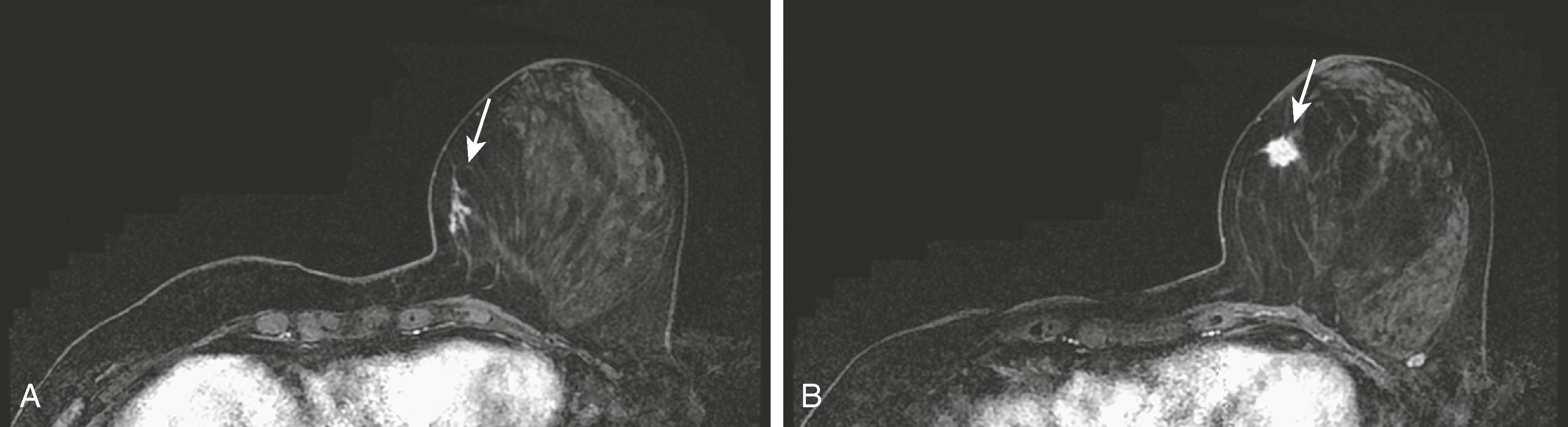Fig. 8.27, ( A ) Ductal carcinoma in situ (DCIS) with an enhancing ductal branching pattern (arrow) on magnetic resonance imaging. ( B ) Adjacent to the DCIS is an enhancing spiculated mass (arrow) , which was the associated invasive carcinoma.