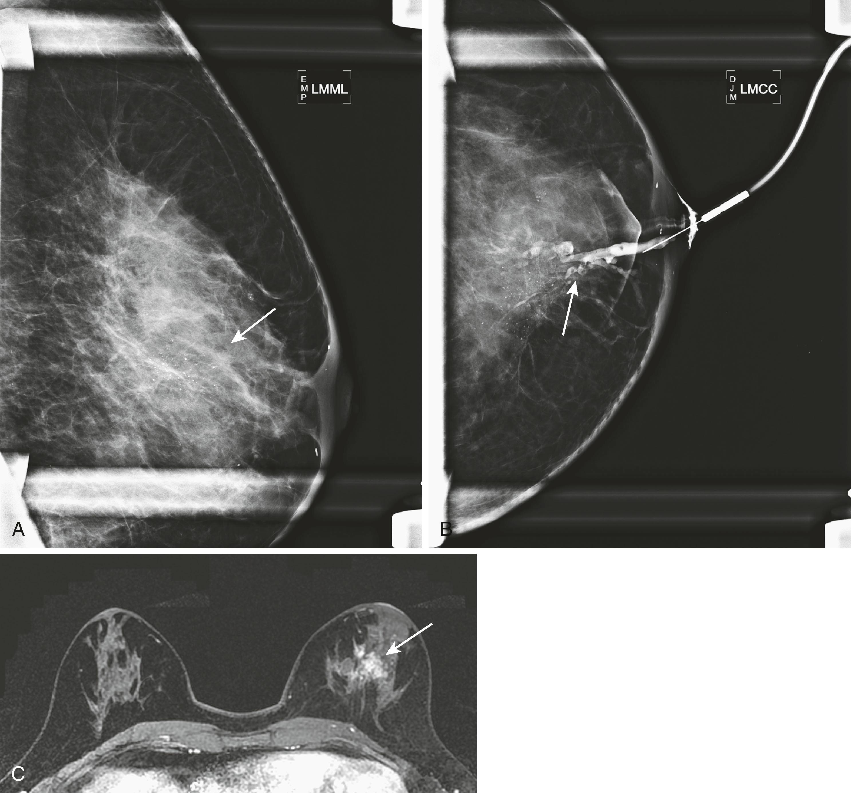 Fig. 8.28, ( A ) Spot magnification 90-degree mammogram shows pleomorphic calcifications in a segmental distribution (arrow) on left mediolateral 90 degree view (LMML). ( B ) Ductogram showed ductal dilatation with filling defects interspersed among the calcifications (arrow) on left craniocaudal view (LMCC). ( C ) Magnetic resonance imaging shows a corresponding area of nonmass enhancement (arrow) , which was ductal carcinoma in situ.