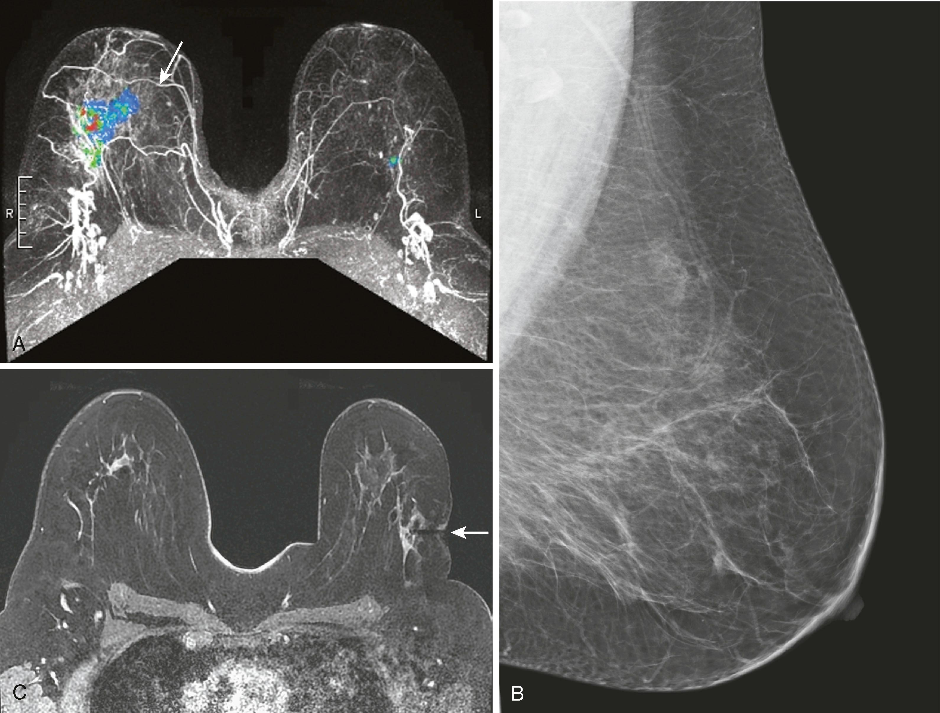 Fig. 8.29, ( A ) Color maximal intensity projection from magnetic resonance imaging (MRI) examination shows a large invasive lobular carcinoma in the right breast (solid arrow) and contralateral ductal carcinoma in situ of the left breast. ( B ) Mediolateral oblique mammogram of the left breast demonstrates no abnormality. ( C ) Because the lesion could not be seen by ultrasound and mammography, MRI-guided biopsy was used when a biopsy was performed on the lesion. The needle guide is seen as a black signal void (arrow) .