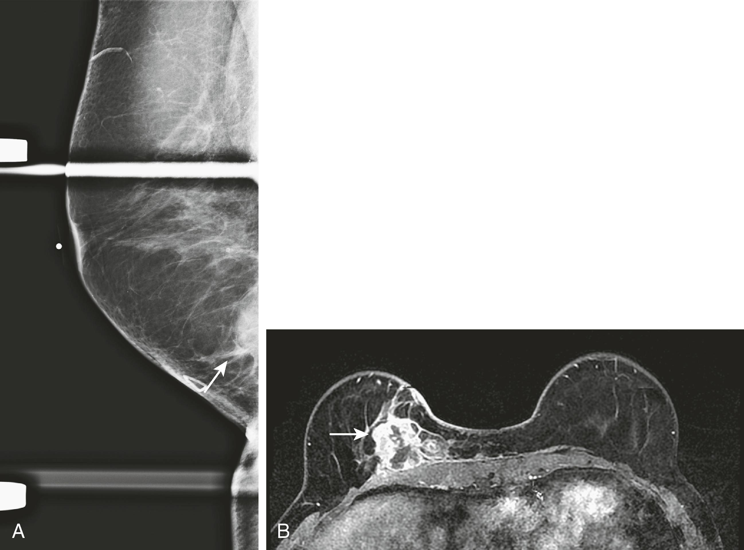 Fig. 8.30, ( A ) A 57-year-old woman has a palpable mass partially seen on spot compression mediolateral oblique views (arrow) . ( B ) Magnetic resonance imaging shows a much larger tumor (arrow) than originally expected based on the physical examination and mammogram.