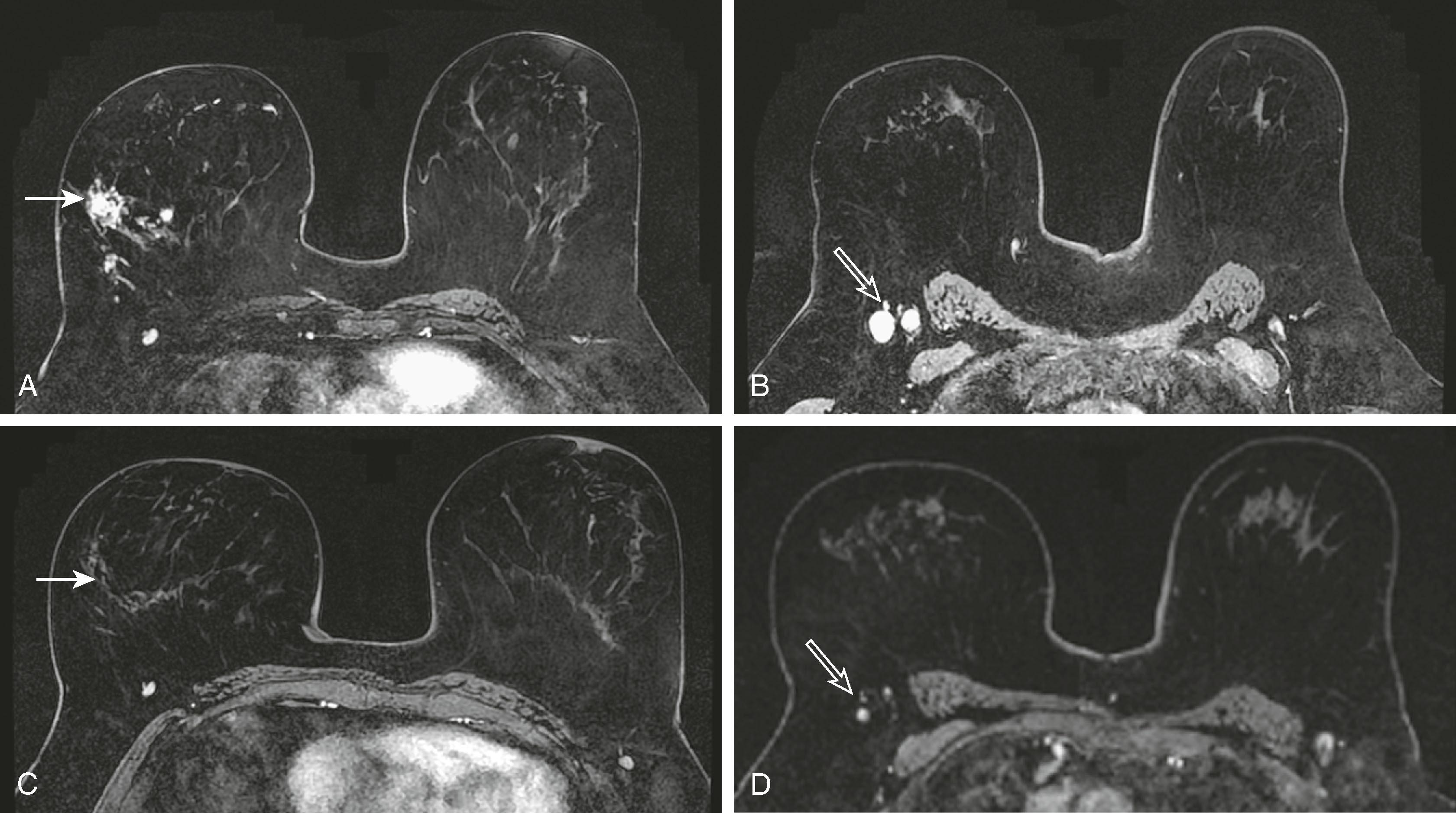 Fig. 8.31, Patient with a history of lobular carcinoma ( solid arrow in A ) and enlarged right axillary lymph nodes ( open arrow in B ). After the administration of neoadjuvant chemotherapy, all magnetic resonance imaging evidence of the tumor ( solid arrow in C ) and lymphadenopathy ( open arrow in D ) disappears.