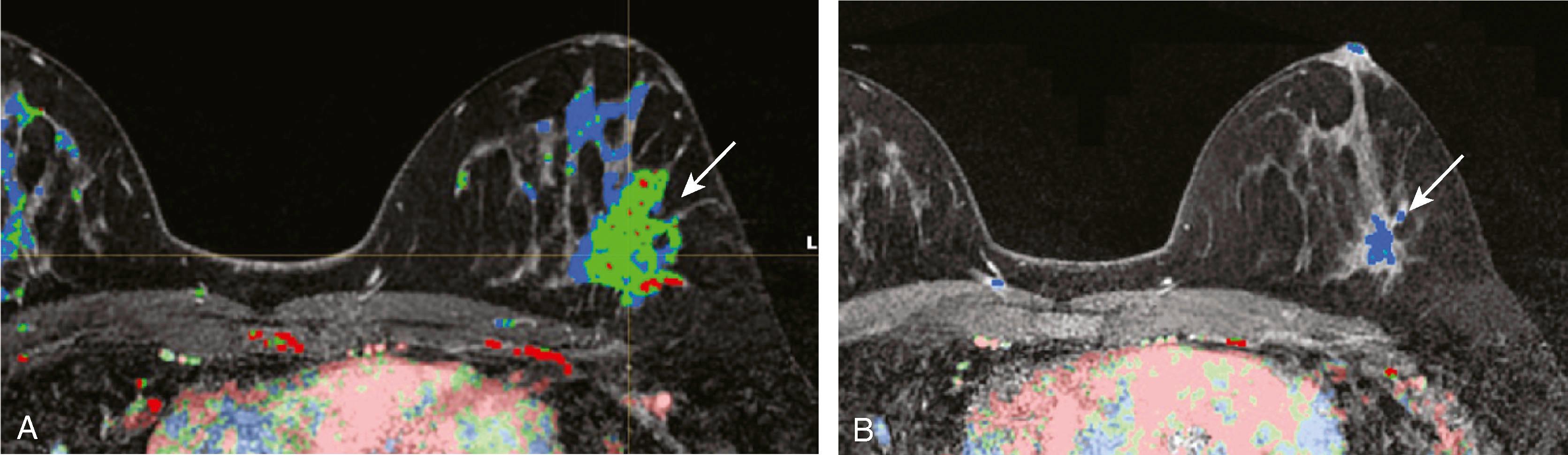 Fig. 8.32, ( A ) Invasive ductal carcinoma in the left breast (arrow) before chemotherapy. ( B ) After chemotherapy, there is a partial response. The tumor is smaller (arrow) , and the washout pattern has changed from plateau to progressive.