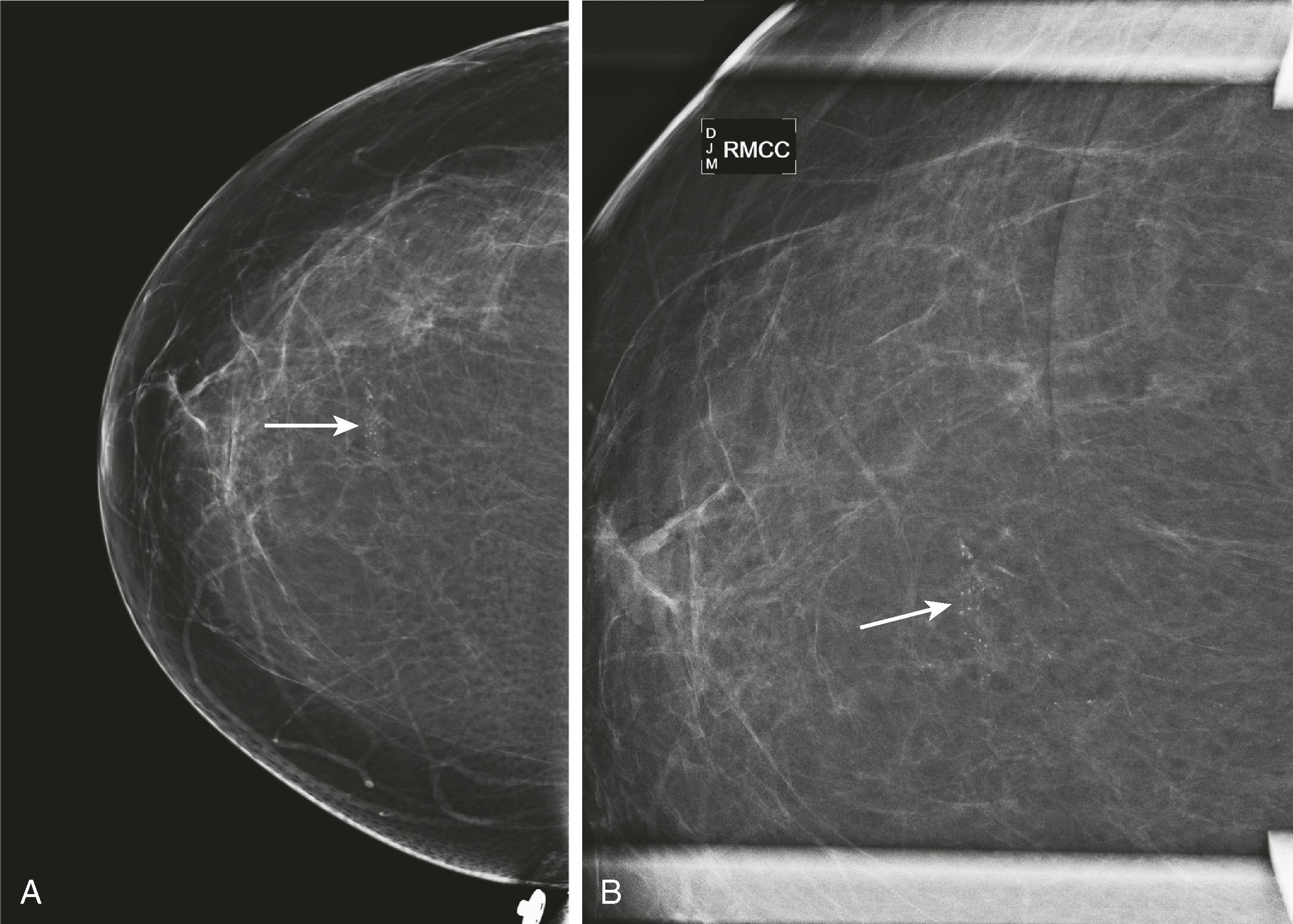 Fig. 8.5, ( A ) Routine right craniocaudal (CC) and ( B ) spot CC magnification views show pleomorphic malignant-appearing calcifications (arrows) . Invasive ductal carcinoma and ductal carcinoma in situ with comedonecrosis, both nuclear grade 3, were shown on biopsy and confirmed at surgical excision.
