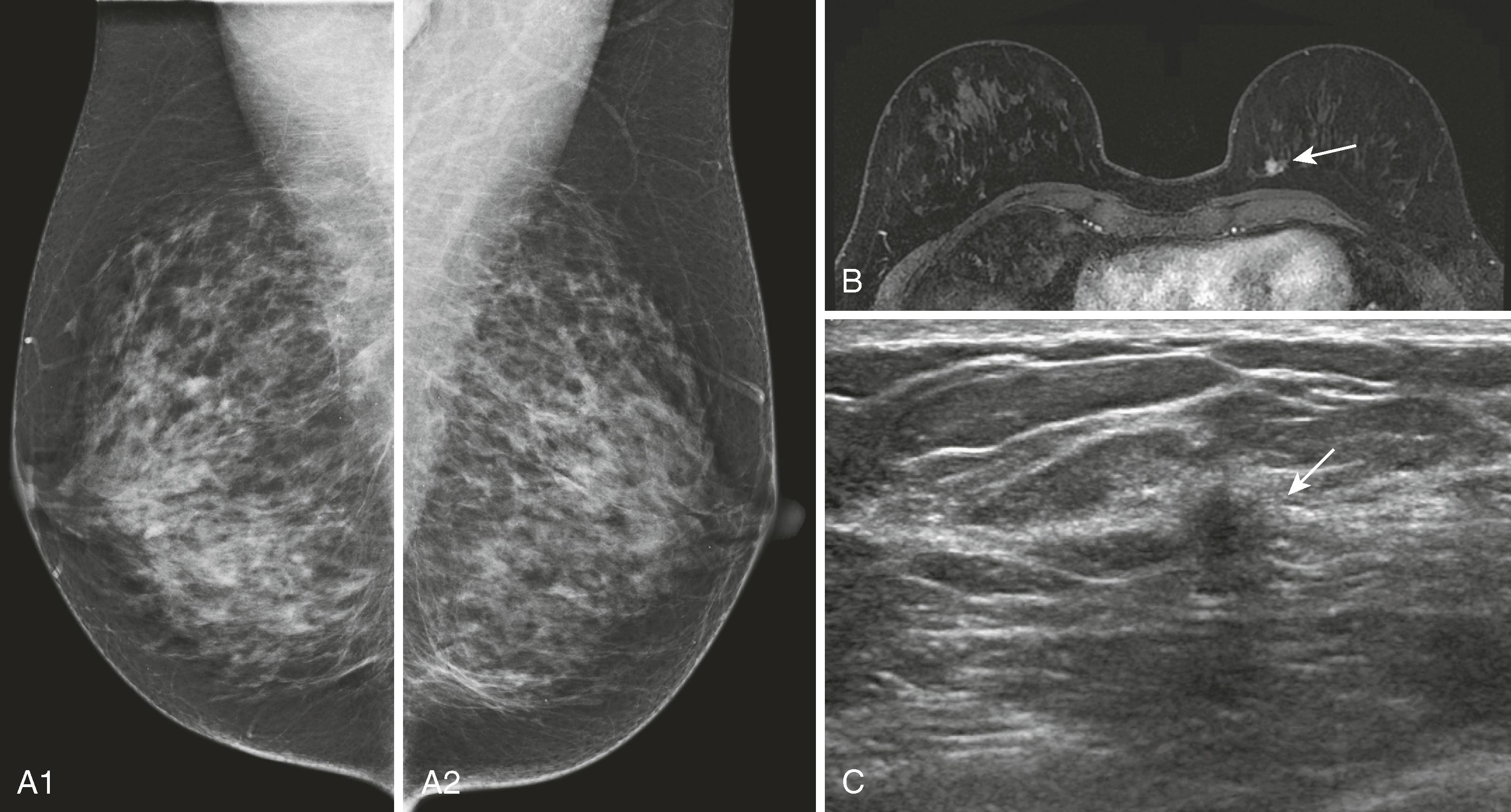 Fig. 8.34, ( A1 and A2 ) Bilateral screening mammography findings are negative. ( B ) Magnetic resonance imaging demonstrates a small enhancing lesion (arrow) in the medial left breast. ( C ) Patient returned for second-look ultrasound, which revealed a hypoechoic lesion with irregular margins (arrow) . Ultrasound-directed biopsy was performed.