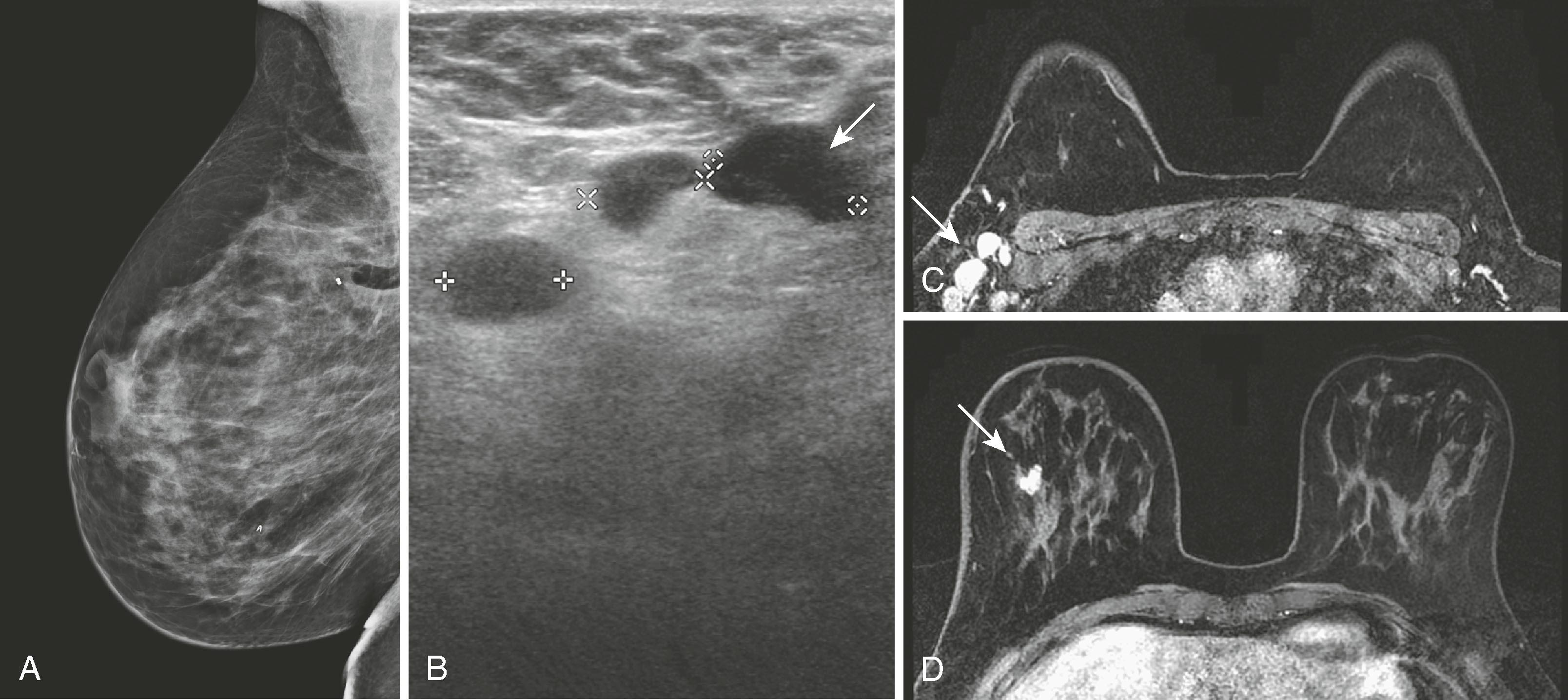 Fig. 8.35, A 42-year-old woman was noted to have prominent right axillary lymph nodes and had excisional biopsy of one of the lymph nodes, which revealed carcinoma. Her mammogram did not reveal the primary carcinoma. ( A ) Abnormal mammogram of the right breast. ( B ) Right axillary ultrasound demonstrates enlarged lymph nodes (arrow) . ( C ) Magnetic resonance imaging (MRI) demonstrates the right axillary adenopathy (arrow) . ( D ) MRI additionally demonstrates the occult primary breast malignancy (arrow) .