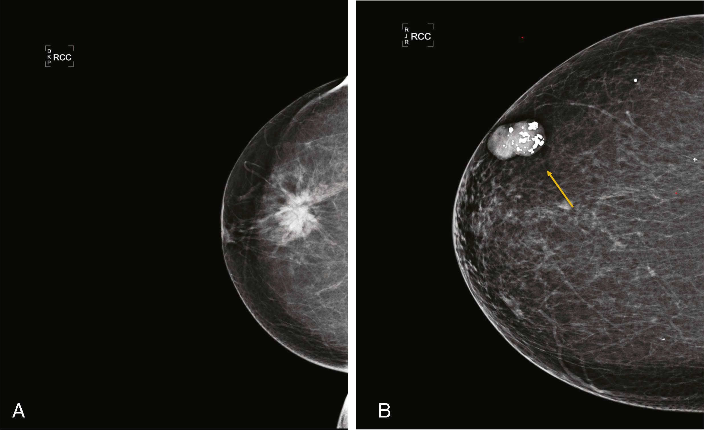 Fig. 8.6, ( A ) Craniocaudal (CC) view of a spiculated mass. Core biopsy revealed invasive duct carcinoma and ductal carcinoma in situ, nuclear grade 2. ( B ) CC view of a typical calcifying fibroadenoma (arrow) .