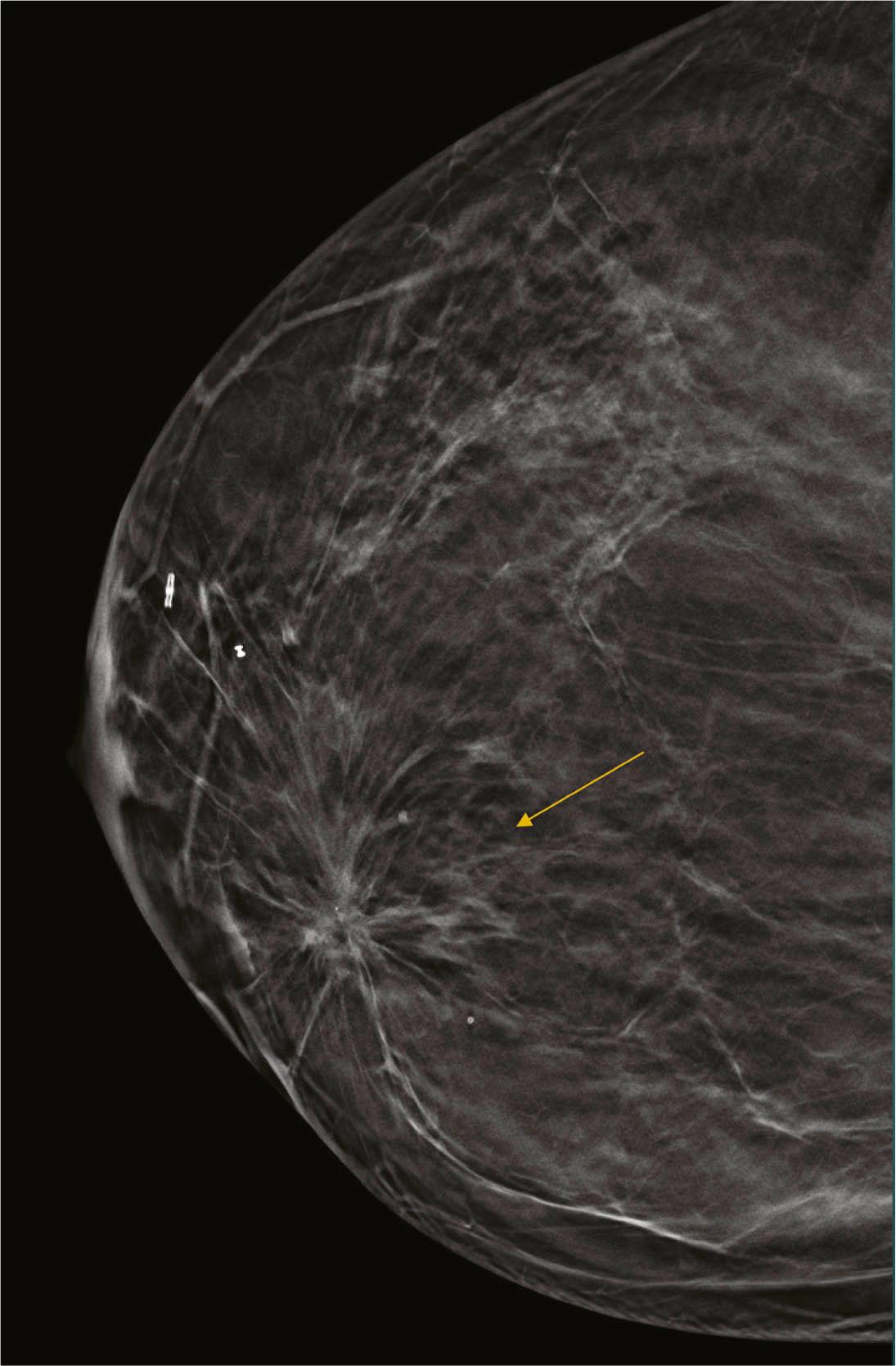 Fig. 8.7, Craniocaudal (CC) tomosynthesis image clearly shows the architectural distortion (arrow) due to lumpectomy scar.