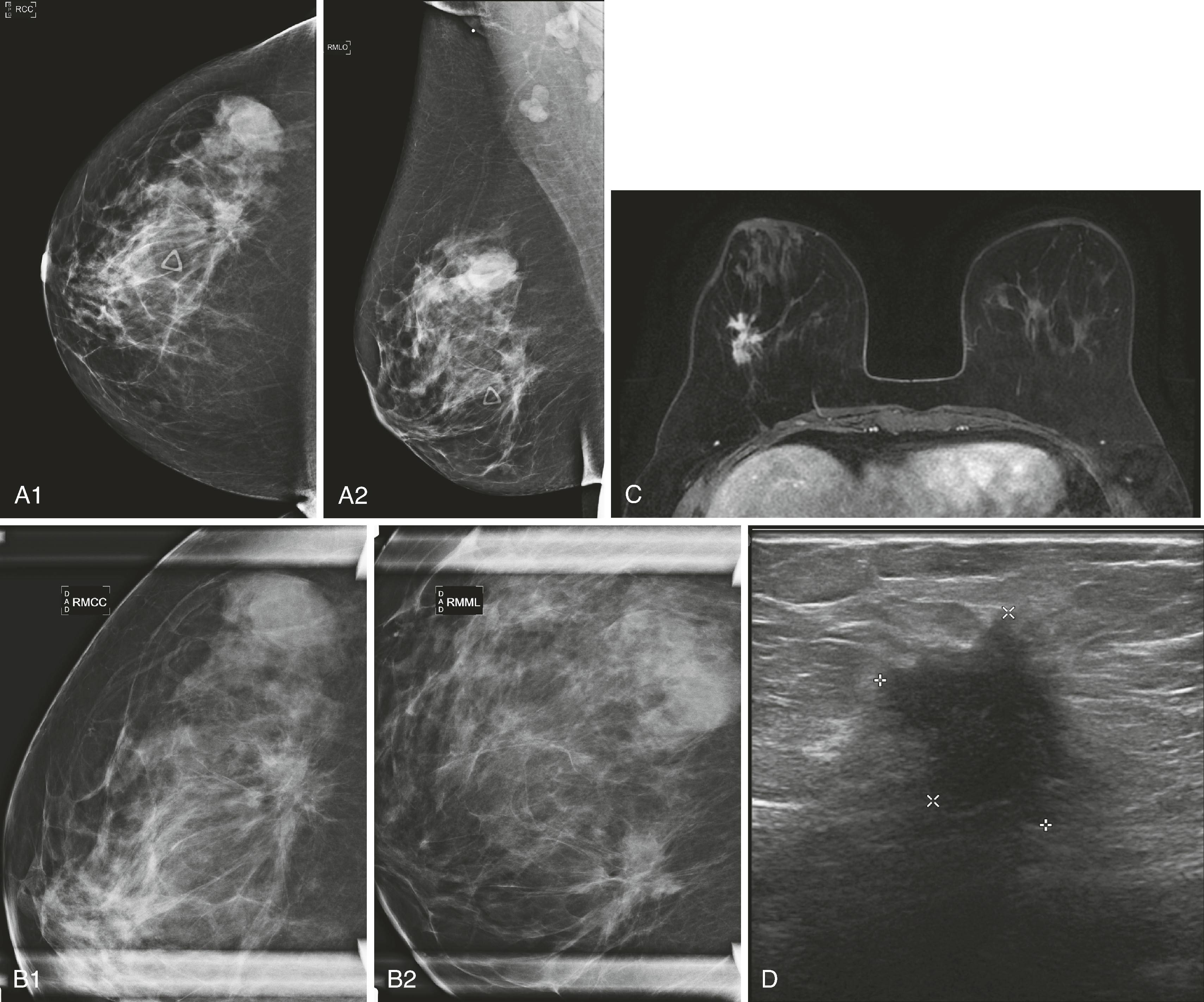 Fig. 8.8, ( A1 and A2 ) Craniocaudal (CC) and mediolateral oblique (MLO) routine images and ( B1 and B2 ) CC and ML spot magnification views of focal asymmetry reveal a spiculated mass. ( C ) Magnetic resonance imaging and ( D ) ultrasound images of the same lesion. RMCC , Right magnification craniocaudal; RMML , right magnification mediolateral.