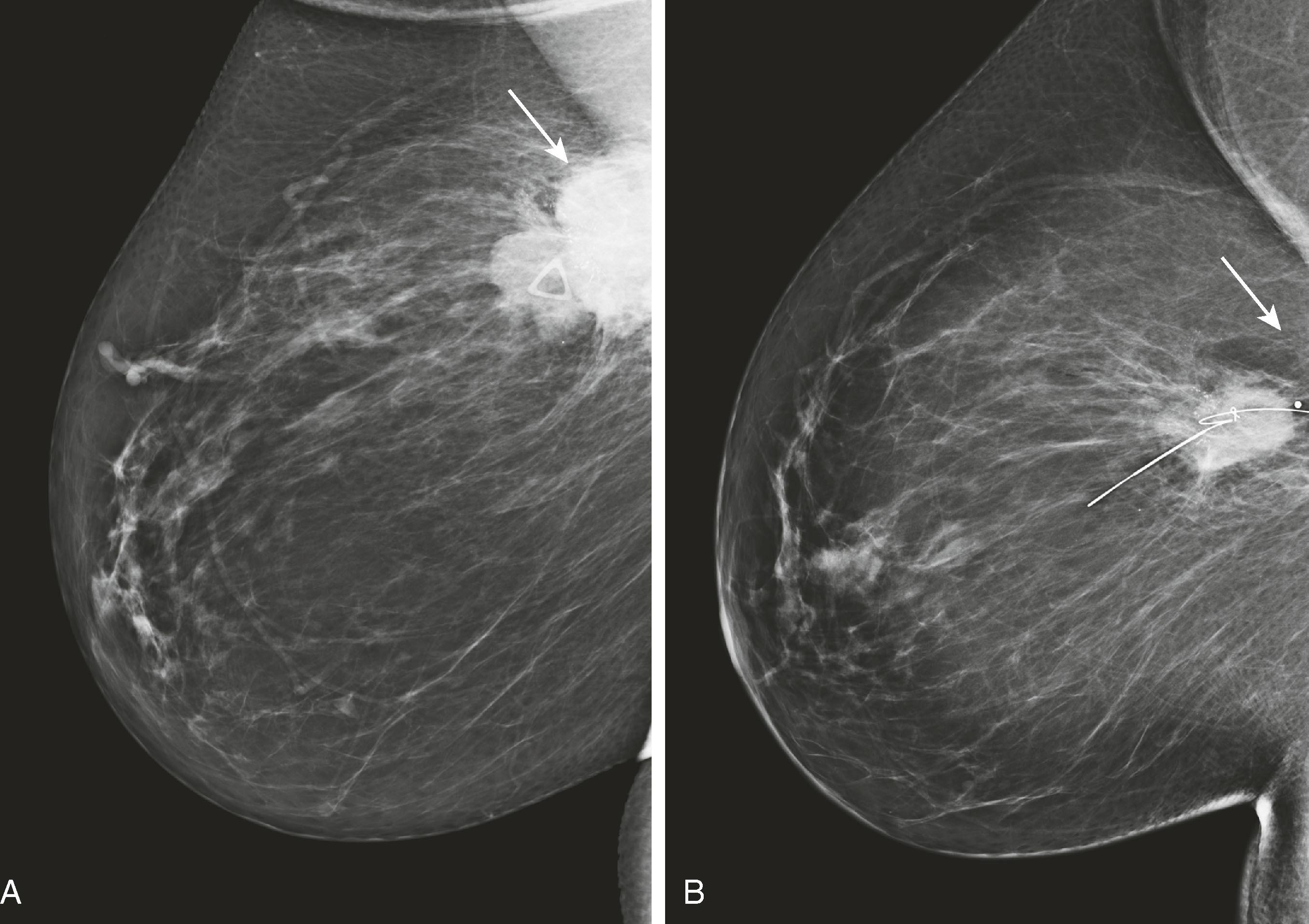 Fig. 8.10, An oblique view before ( A ) and after ( B ) 8 months of neoadjuvant chemotherapy ( arrows mark the known carcinoma, shown to be smaller after neoadjuvant chemotherapy). This allowed for improved cosmesis after a smaller lumpectomy. ( B ) contains the localizing wire.