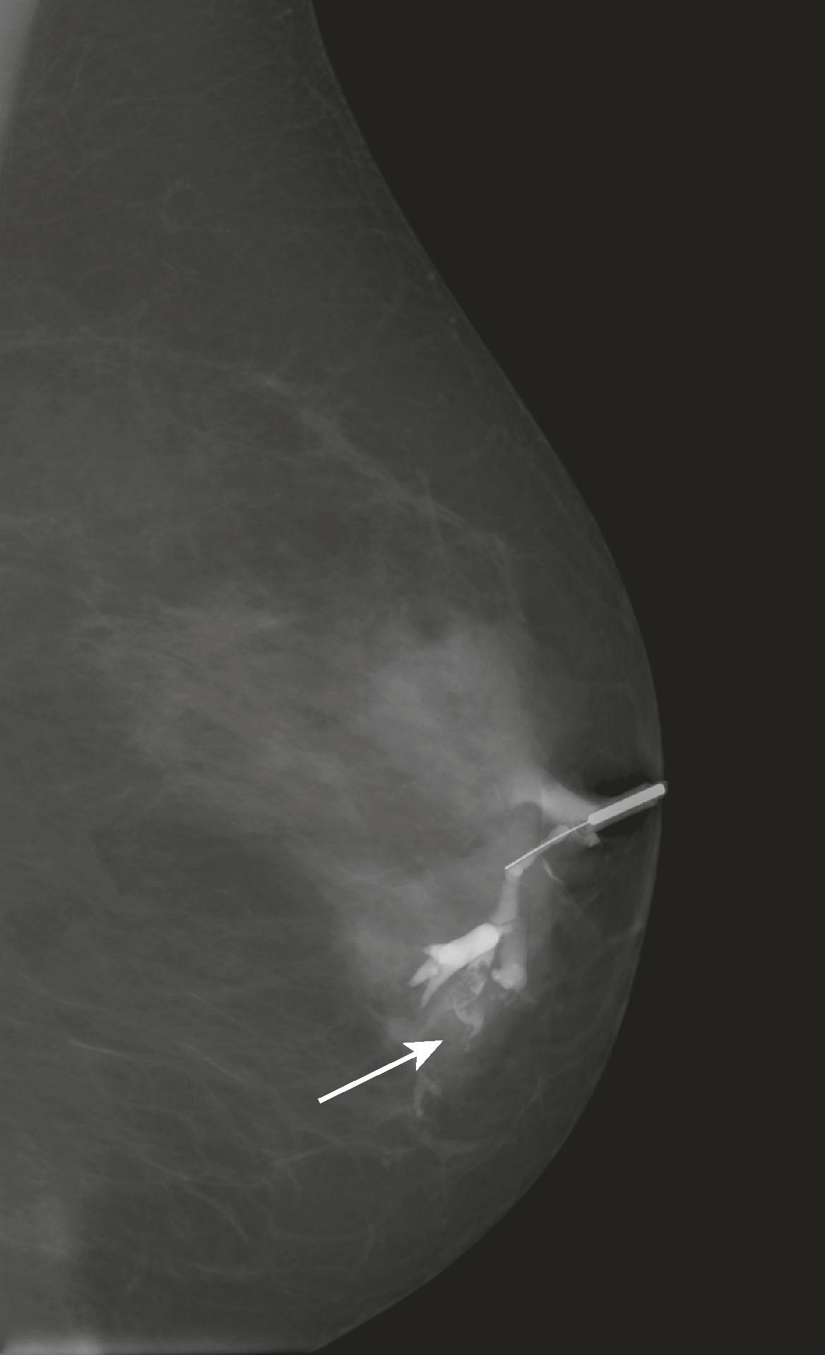 Fig. 8.11, Single ductogram image shows contrast outlining a lobulated filling defect (papilloma; arrow ).