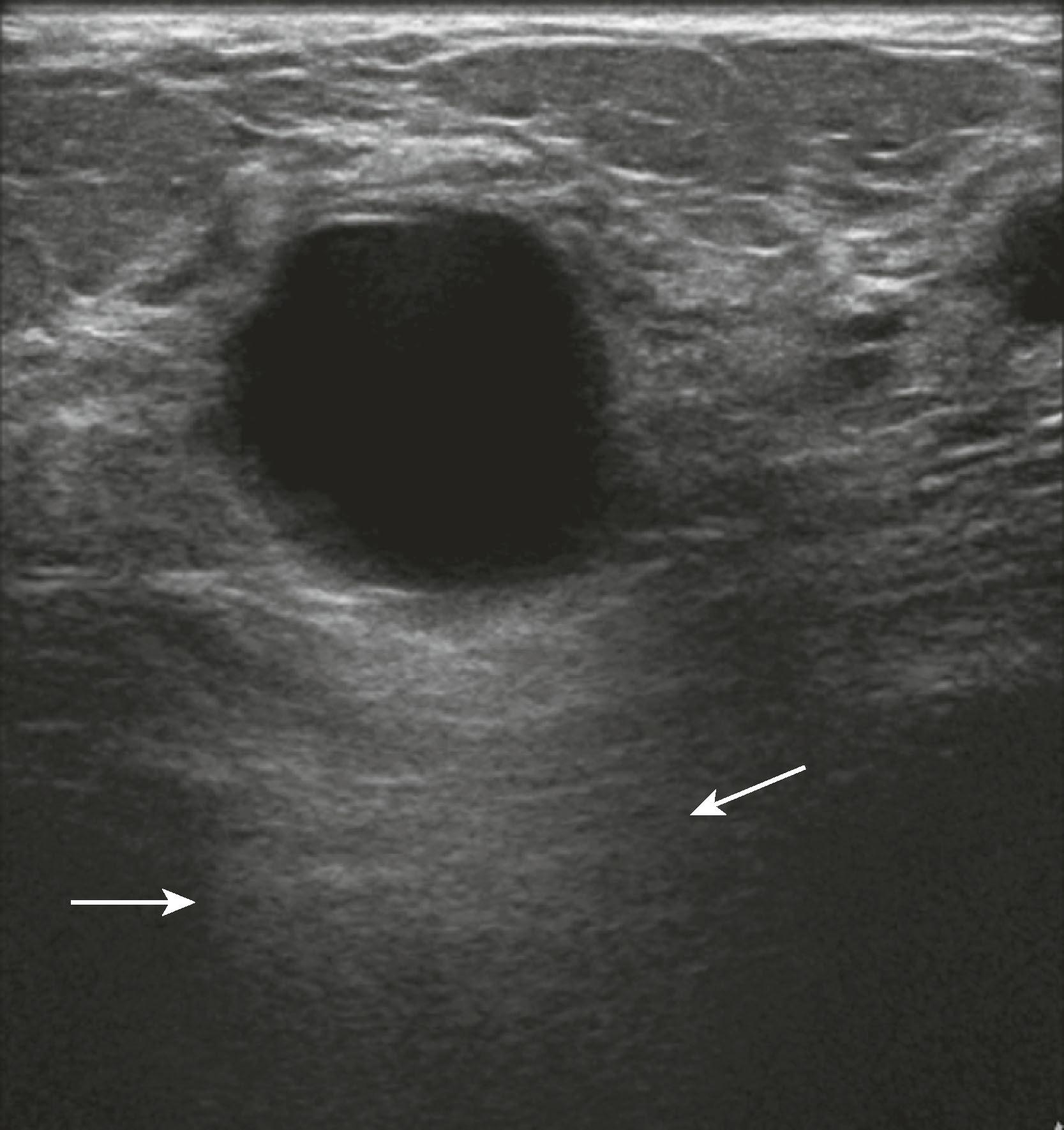 Fig. 8.12, A simple cyst is anechoic (no internal echoes) because it is fluid filled and has no interfaces within, has smooth walls, and exhibits acoustic enhancement (arrows) owing to greater transmission of sound through fluid compared with adjacent tissue, where more sound is absorbed or reflected owing to the multiple interfaces in solid tissue.