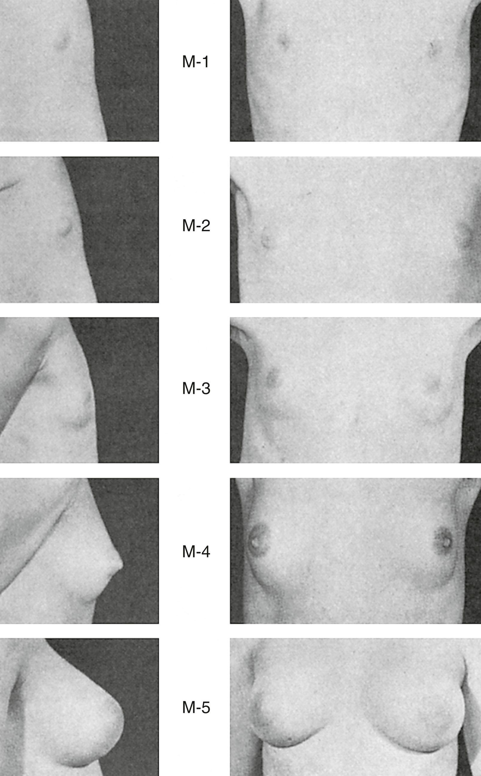 Fig. 5.11, Stages of breast development. Stage 1 is preadolescent, with slight elevation of the papilla. In stage 2, there is elevation of the breast and papilla as a small mound, with an increase in size of the areola. Stage 3 is characterized by further enlargement of the breast. In stage 4, the areola and papilla form a secondary mound above the level of the breast. In stage 5, the areola recedes into the general contour of the breast.