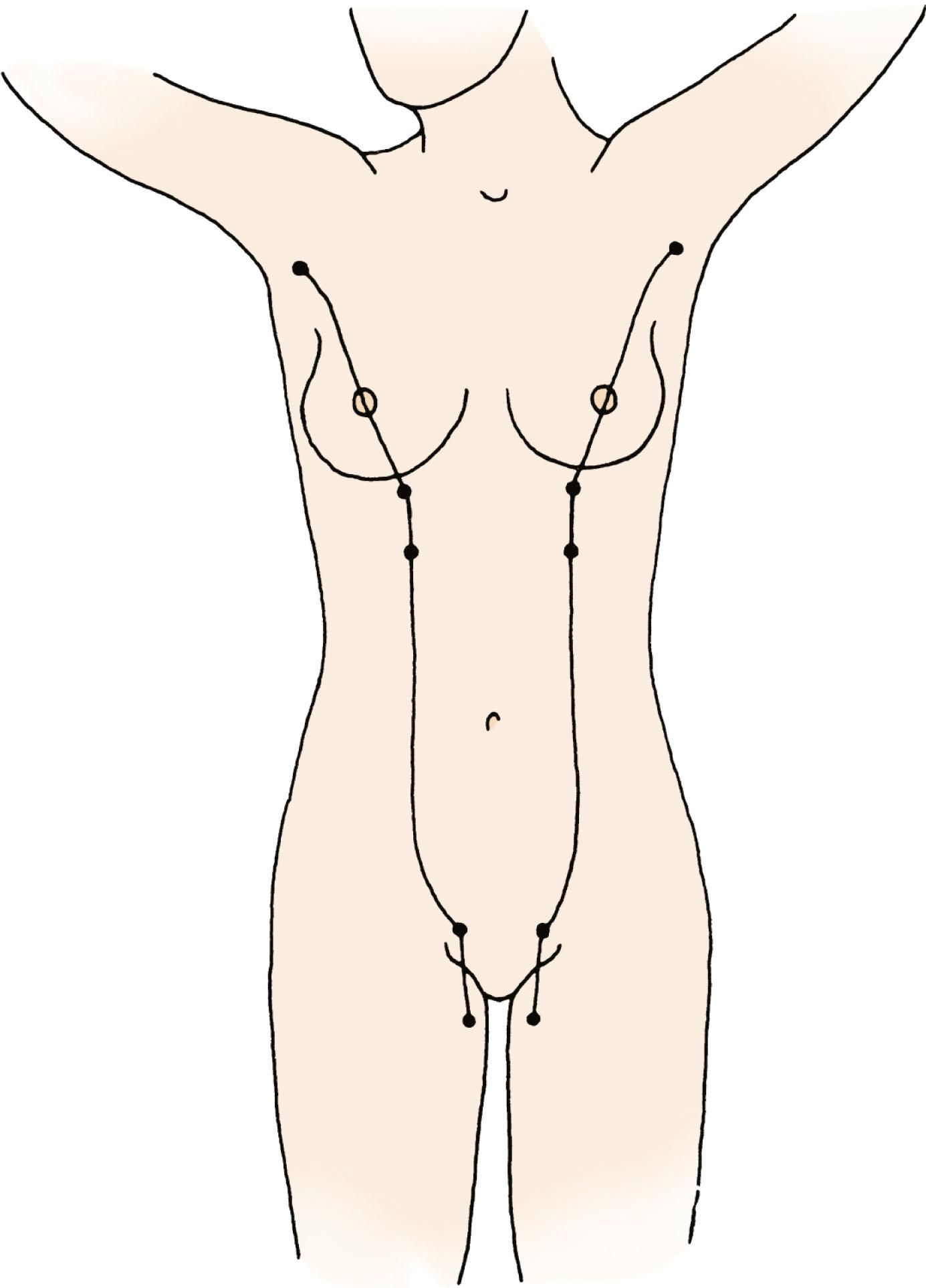 Fig. 5.2, Mammary milk line. After development of the milk bud in the pectoral area of ectodermal thickening, the “milk streak” extends from the axilla to the inguinal areas. At week 9 of intrauterine development, atrophy of the bud has occurred except for the presence of the supernumerary nipples or breast.