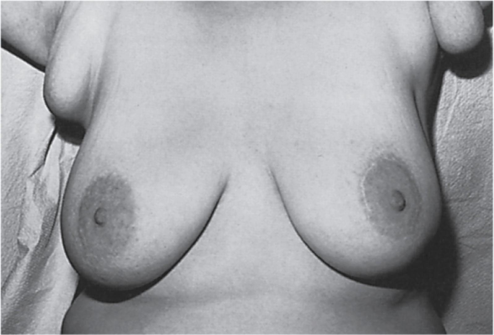 Fig. 5.4, Supernumerary breasts presenting as accessory (ectopic) breast tissue bilaterally in the axilla.