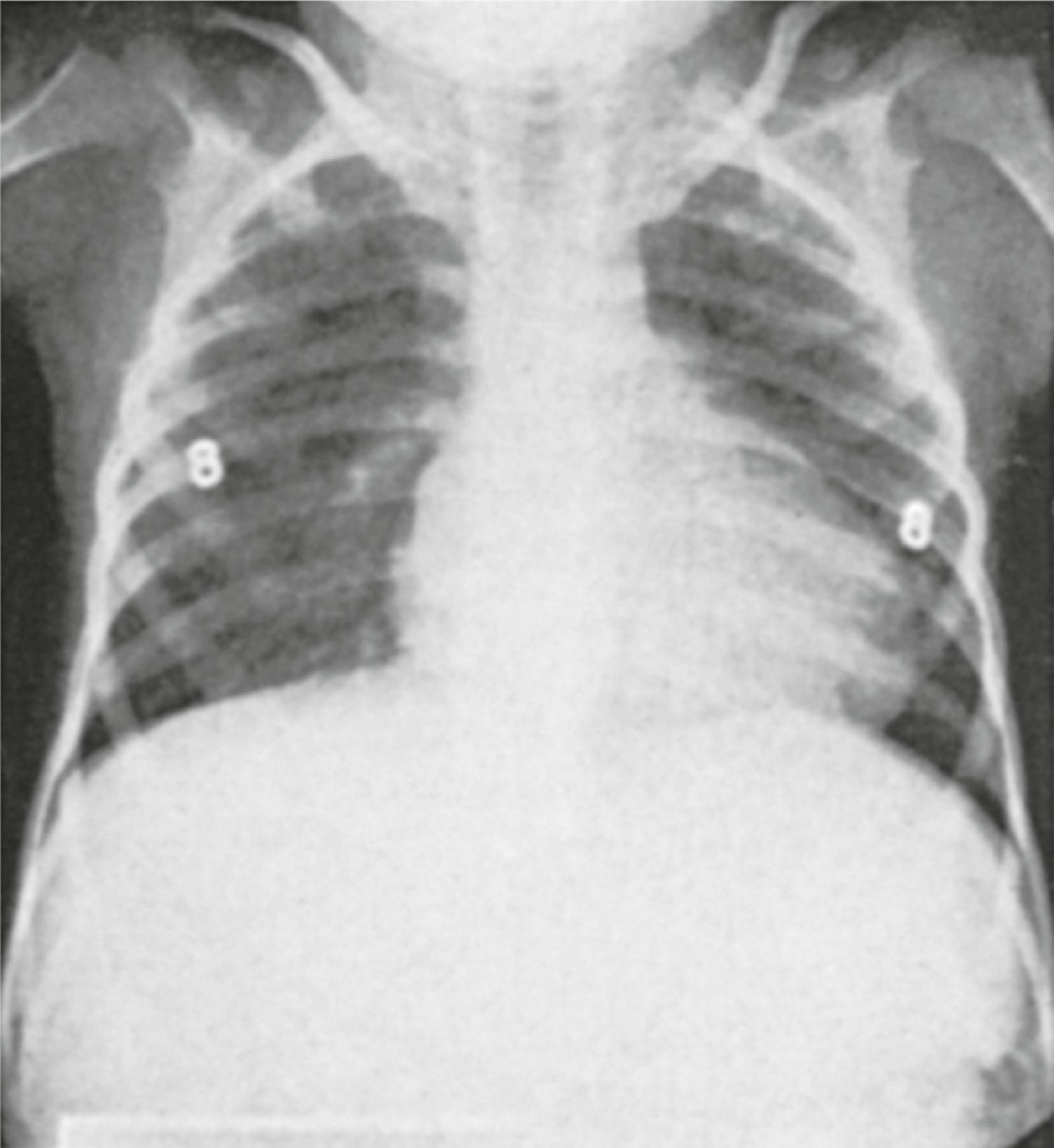 Fig. 5.6, Fleisher syndrome. Posteroanterior chest roentgenogram of a 5-year-old with bilateral renal hypoplasia. Although the clavicles are not horizontal, the lateral displacement of the nipples (designated by the lead markers 8) is apparent.