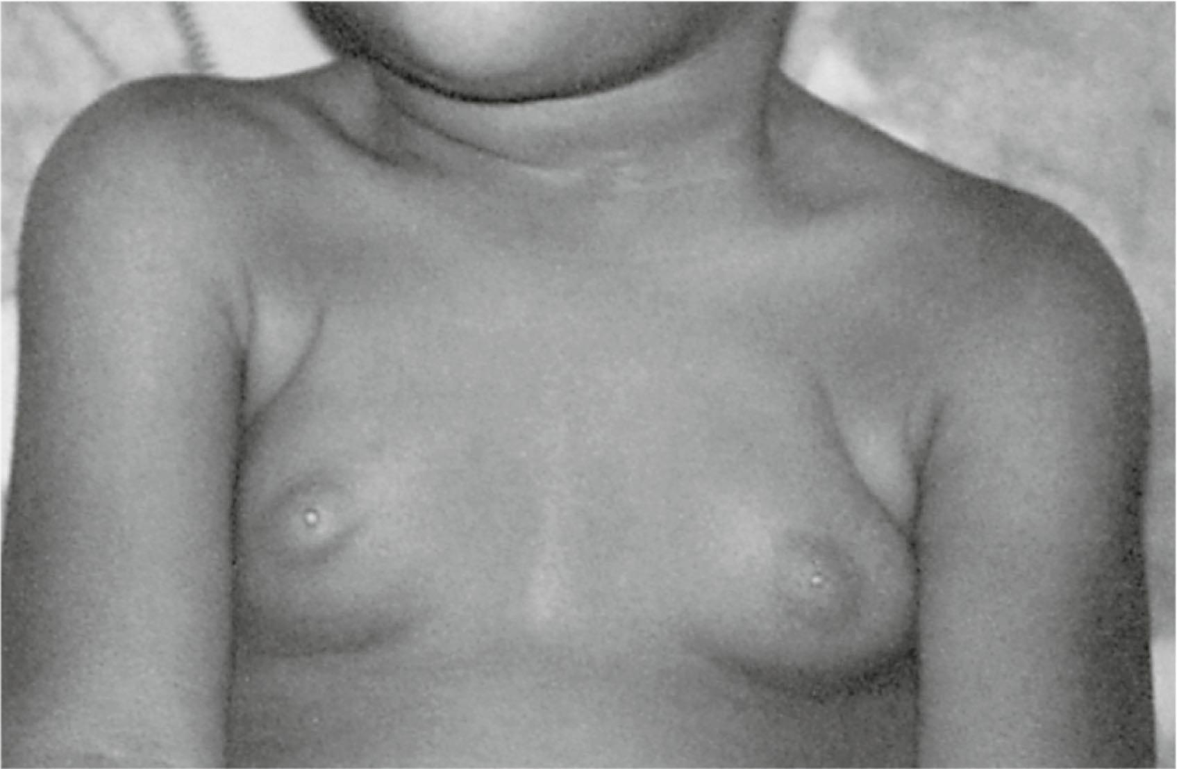Fig. 5.8, Premature thelarche. Fourteen-month-old child with breast development from birth. Height was at the 50th percentile without acceleration, and no other signs of sexual maturation were present. Breast development was considered Tanner stage 3 without nipple maturation. There had been some regression over the several months before this picture was taken.