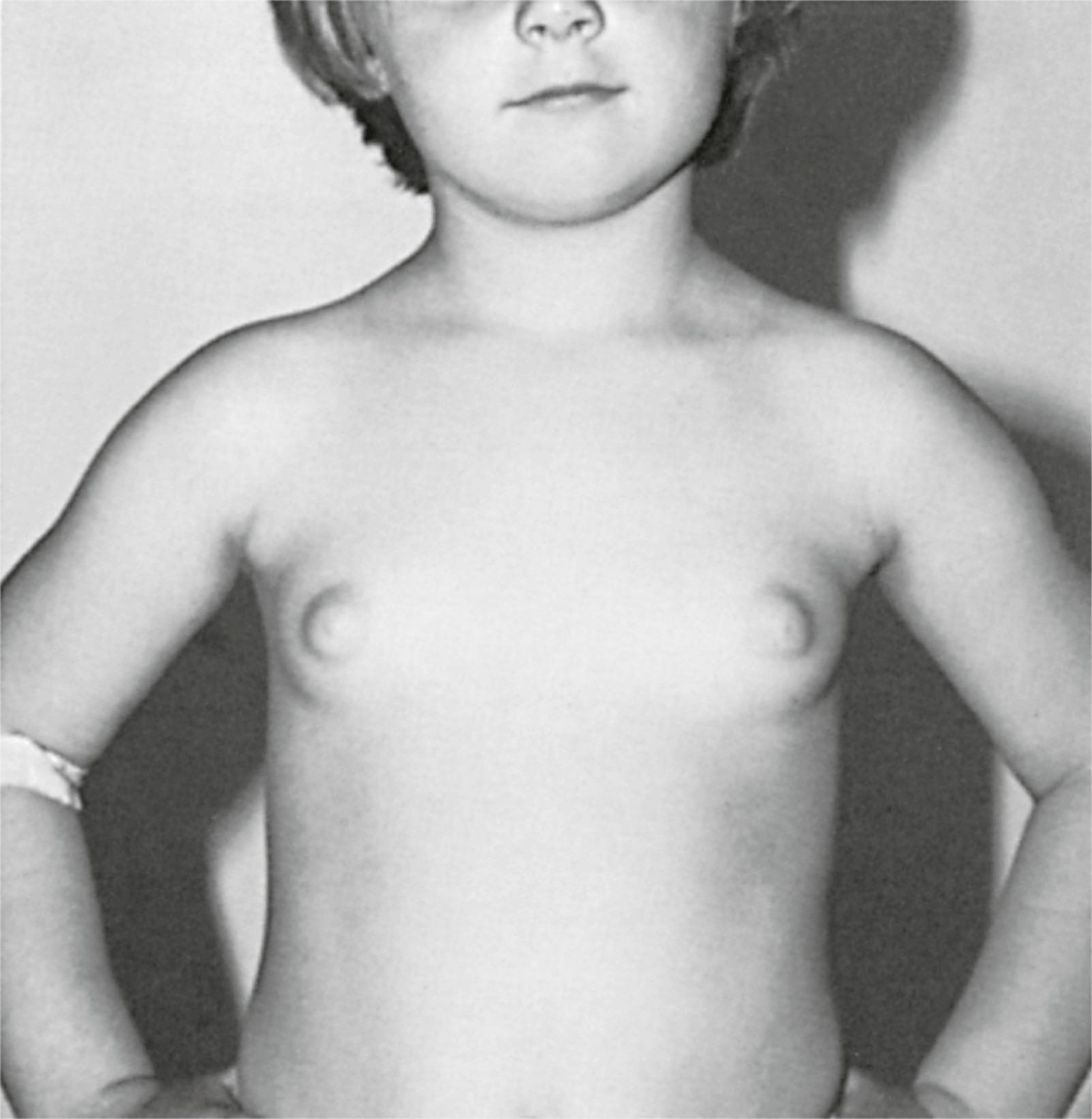 Fig. 5.9, Three-and-a-half-year-old girl with central precocious puberty (adolescent levels of gonadotropins and estrogen). Breast development had been present for only a few months but included nipple maturation. Facial maturation was that of a 5- to 6-year-old child. Height age was 4 1/2 years, and osseous maturation was 5 years, 9 months.