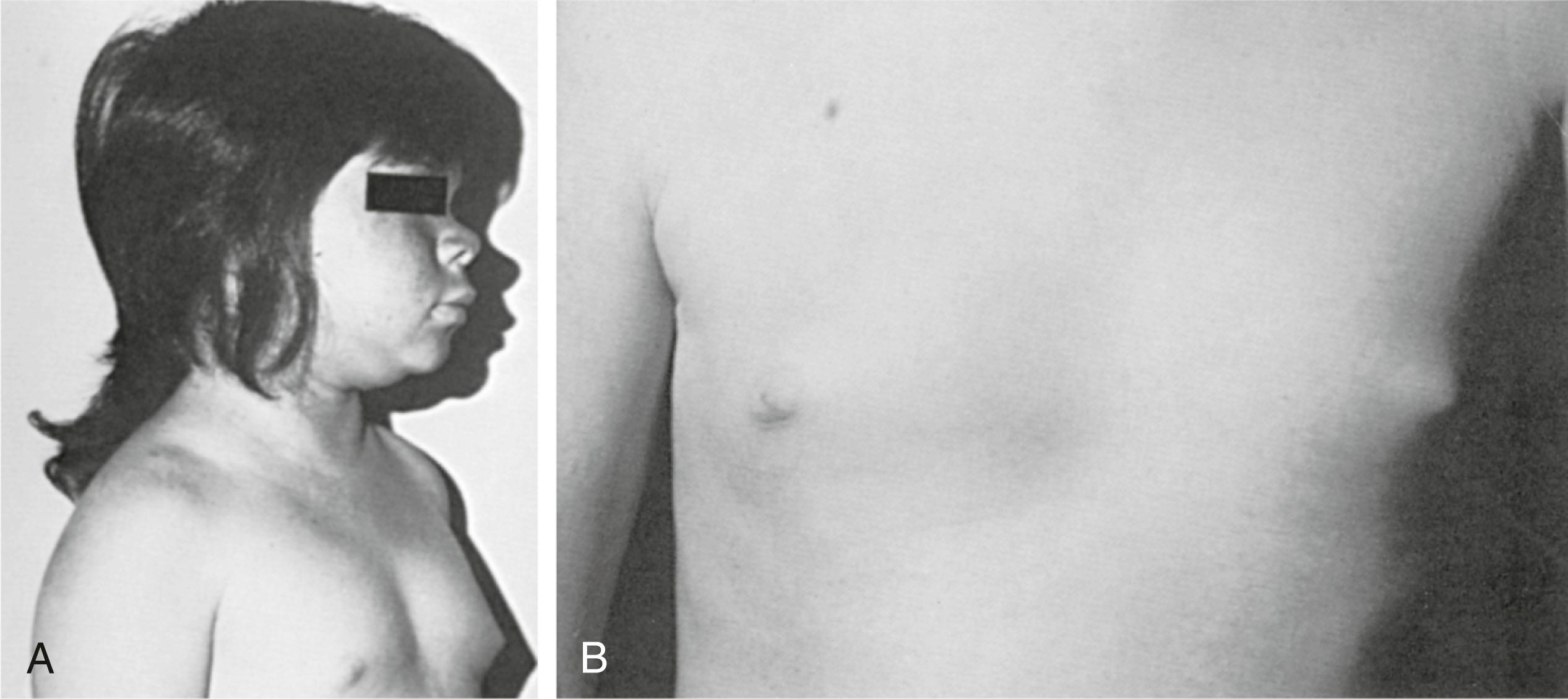 Fig. 5.10, (A) Thirteen-year-old girl with acquired hypothyroidism of approximately 5 years’ duration, with Tanner stage 2 breast development despite osseous maturation of 8 years and comparable height age. (B) Regression of breast development occurred within months of treatment with thyroid hormone.