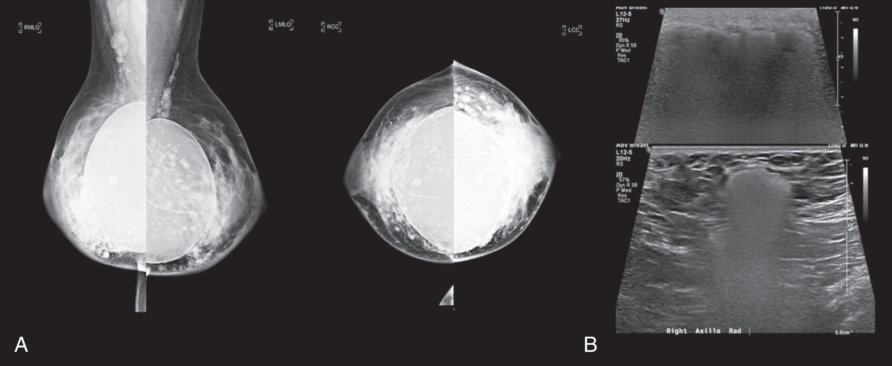 Breast Ultrasound Indications and Interpretation - Clinical Tree