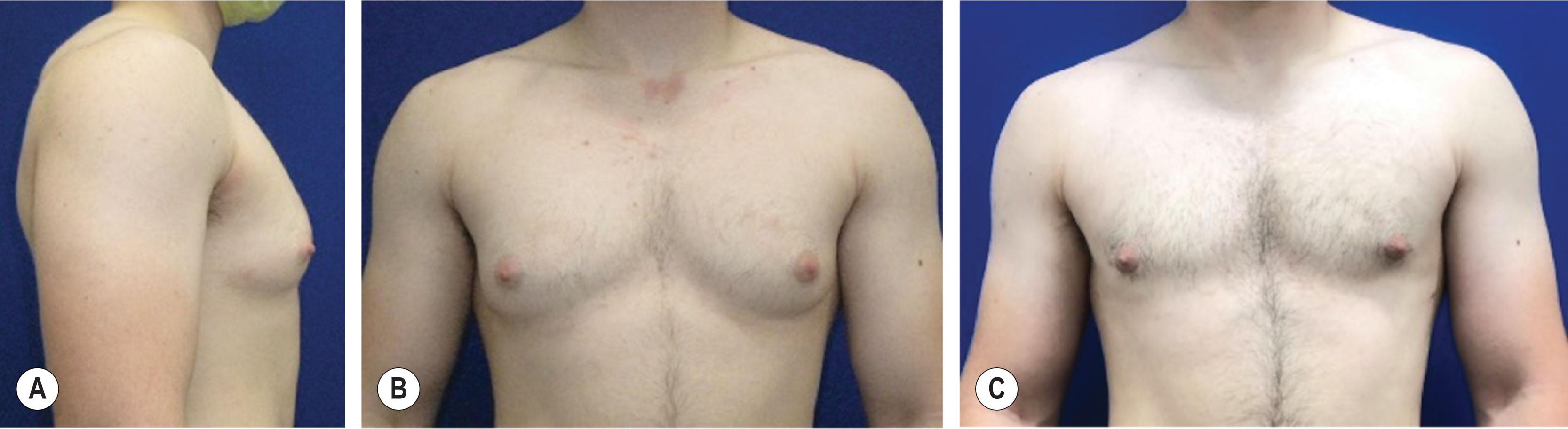 Figure 14.4.1, Preoperative and postoperative results of chest masculinization using the periareolar technique. (A) Lateral view demonstrates obtuse IMF angle. (B) Demonstrates high position of the NAC. (C) Final result with small, well-hidden scars.