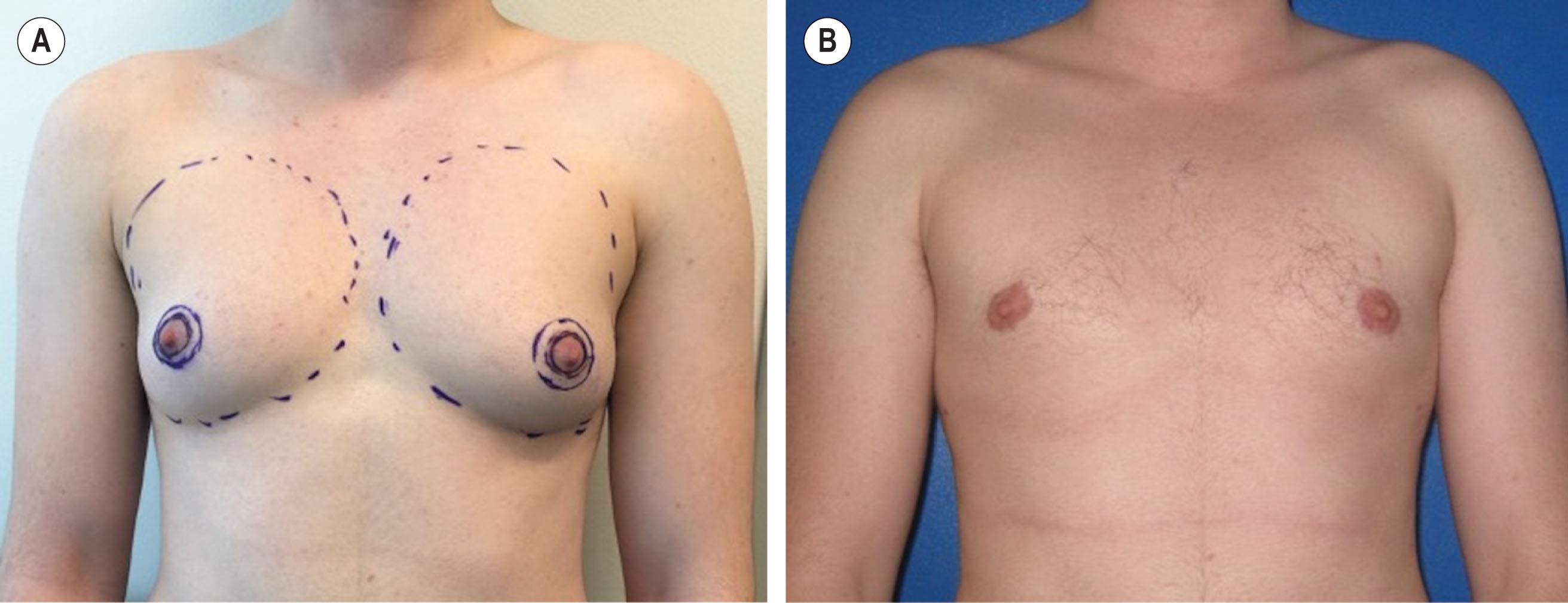 Figure 14.4.2, Preoperative markings (A) and postoperative results (B) of chest masculinization using the circumareolar technique. The breast footprint is marked, in addition to an inner circle within the existing NAC, usually about 2.5 cm in diameter, in addition to an outer circle. The intervening skin is de-epithelialized, and the mastectomy is performed through a full-thickness inferior periarolar dissection.