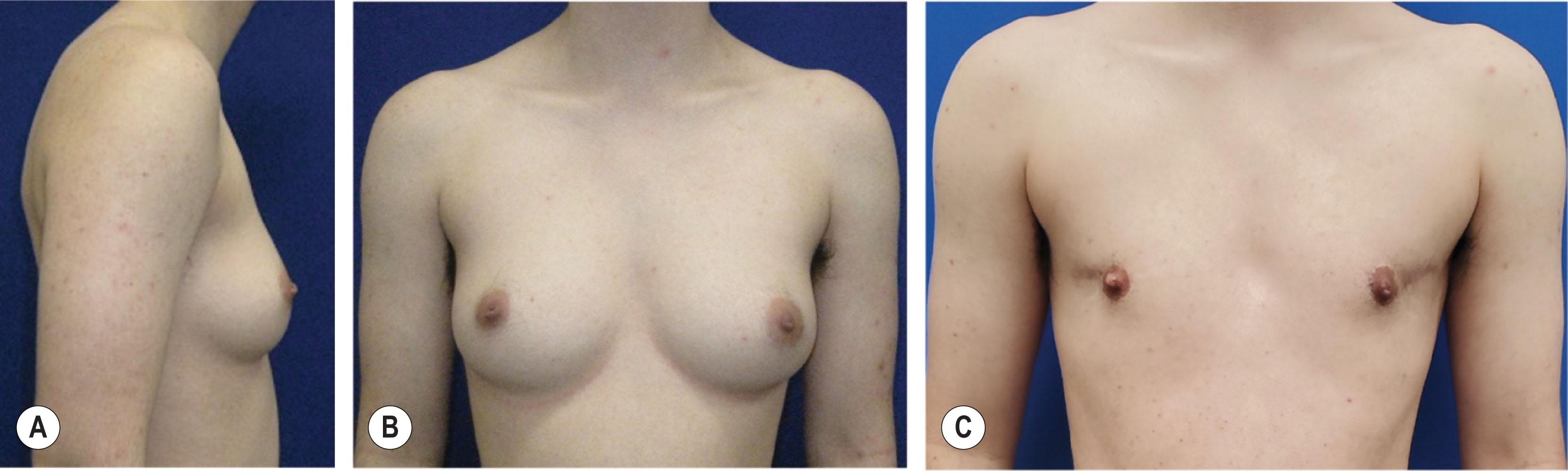 Figure 14.4.3, Preoperative views and postoperative results of chest masculinization using the extended circumareolar technique with lateral extension. (A,B) Preoperative views demonstrate moderate laxity and relatively high NAC position. (C) Resultant lateral scars may be preferable to some patients rather than double incision scars.