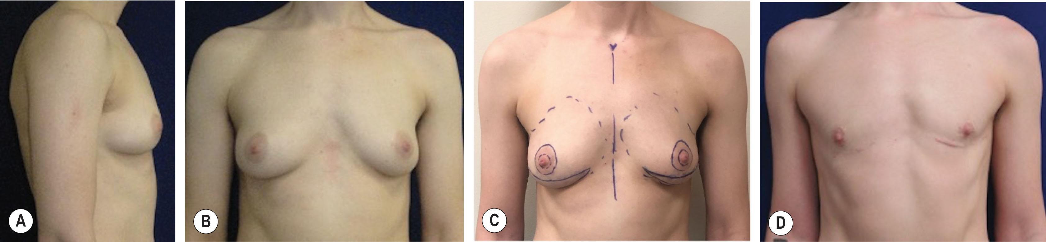 Figure 14.4.4, Preoperative markings and postoperative results of chest masculinization using the extended circumareolar technique with inferior wedge excision. (A) Lateral view shows 90° IMF angle, moderate laxity. (B) AP view shows NACs in relatively high position. (C) Preoperative markings. Mastectomy is performed along the inferior incision, preserving breast parenchyma beneath the NAC. (D) The IMF wedge excision is not completed until the circumareolar de-epithelialization is performed and closed, and scar placement and chest contours are assessed.